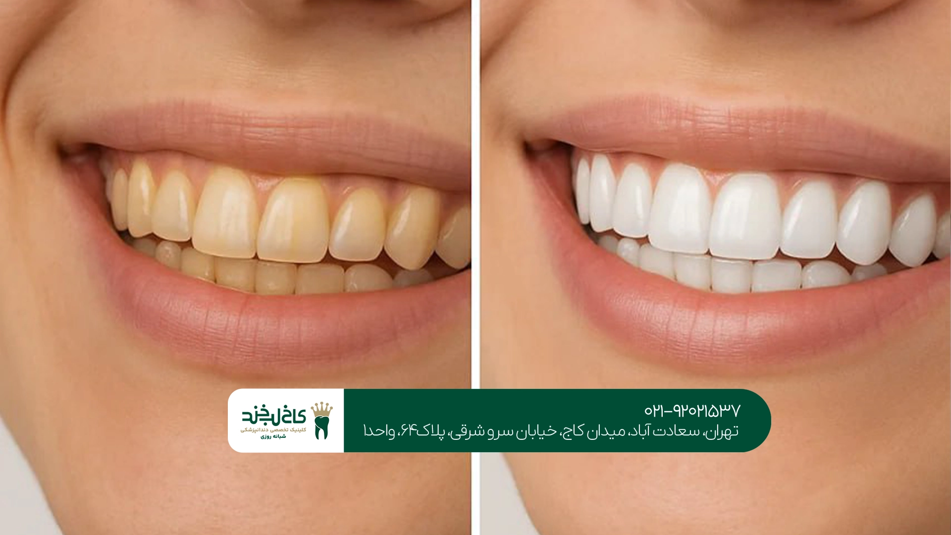 ماندگاری بلیچینگ در مطب ماندگاری بلیچینگ در مطب