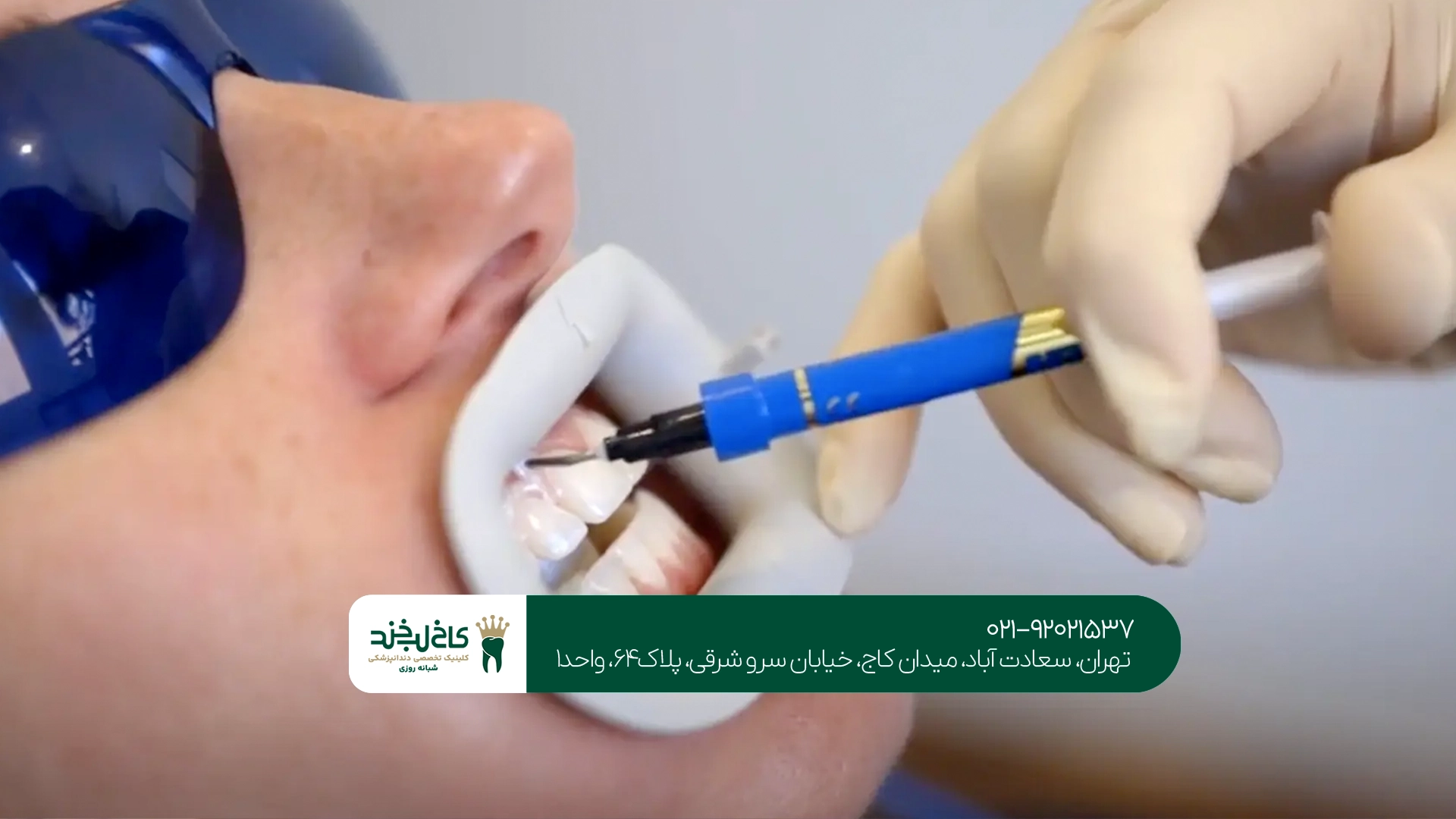 انواع روشهای بلیچینگ دندان انواع روشهای بلیچینگ دندان