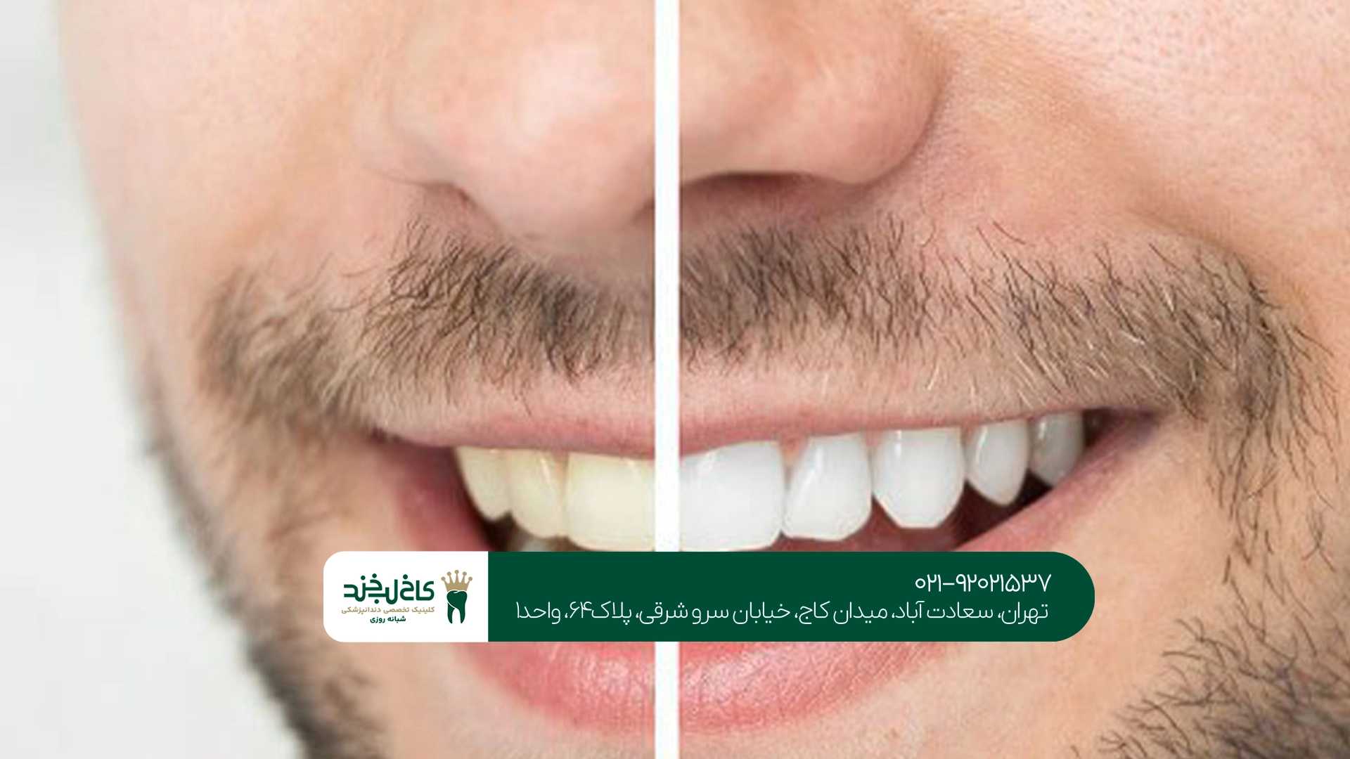 سفید کردن دندان در کلینیک سفید کردن دندان در کلینیک