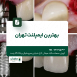 بهترین ایمپلنت تهران