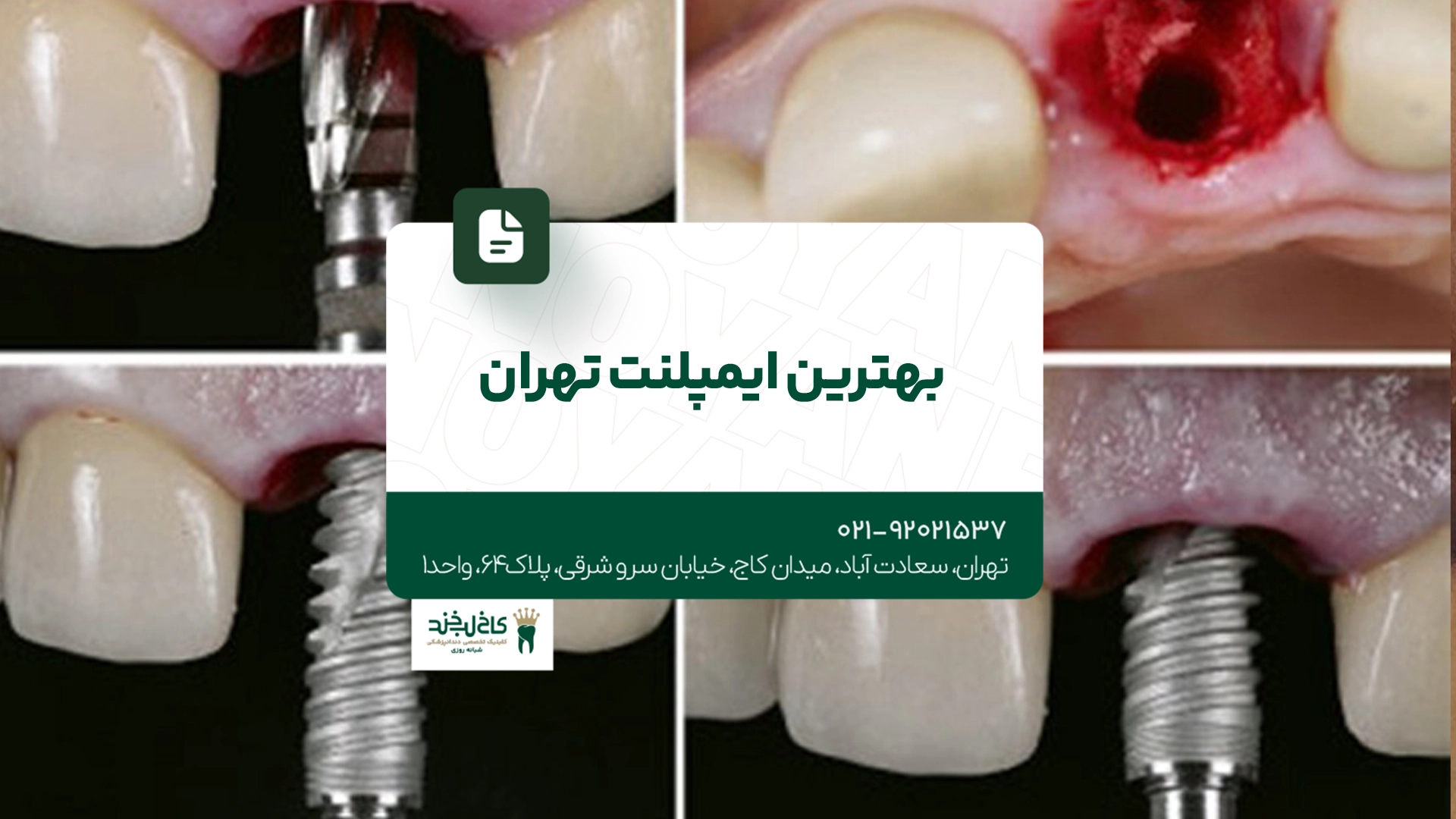 بهترین ایمپلنت تهران بهترین ایمپلنت تهران