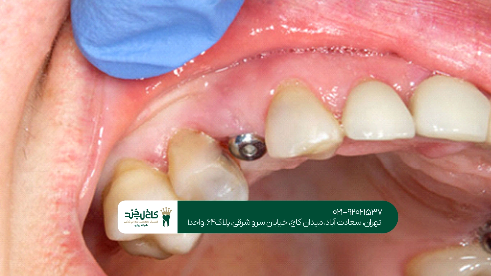 بهترین ایمپلنت تهران چه ویژگیهایی دارد؟ بهترین ایمپلنت تهران چه ویژگیهایی دارد؟