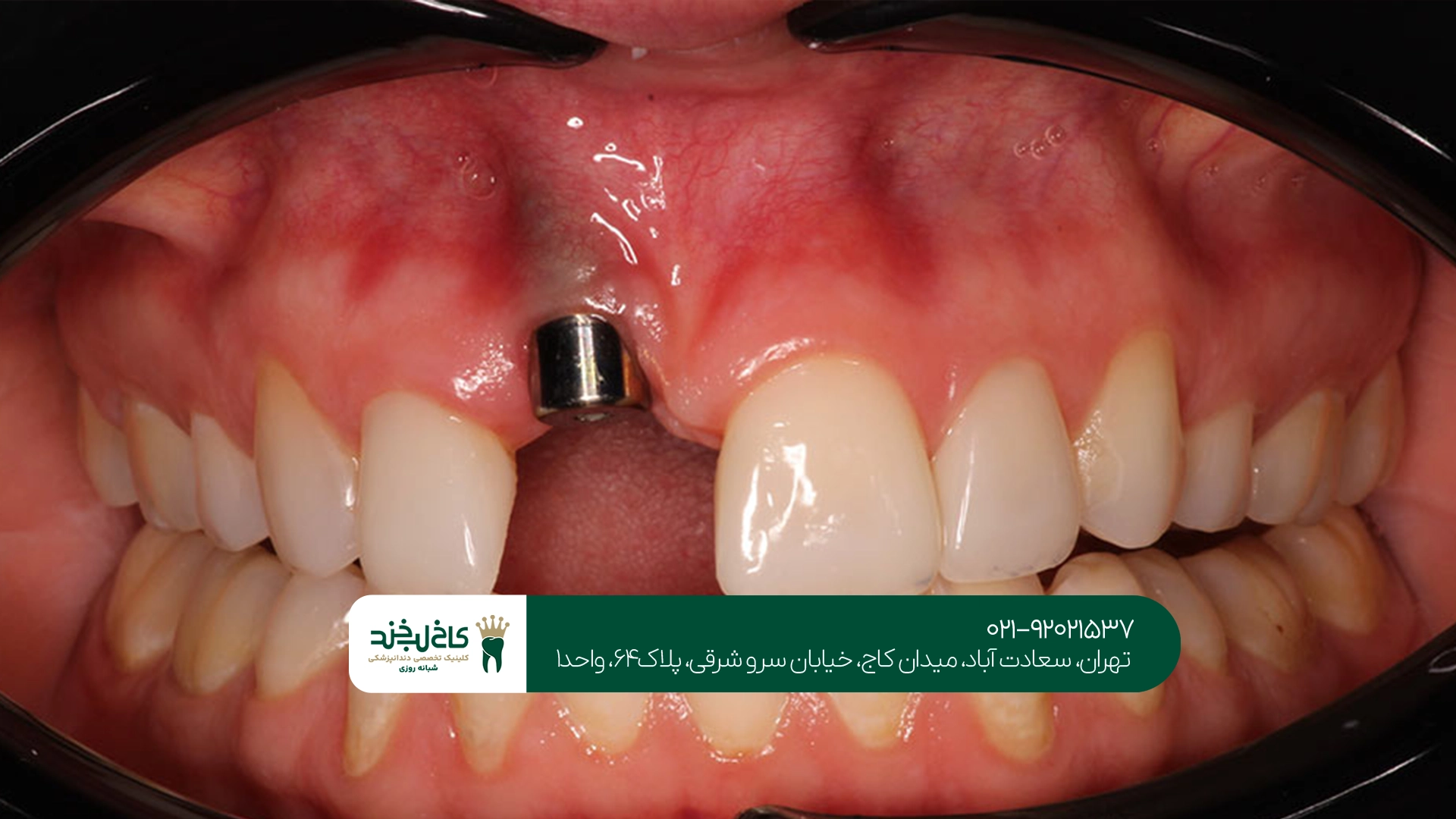 هزینه بهترین ایمپلنت تهران چقدر است؟ هزینه بهترین ایمپلنت تهران چقدر است؟