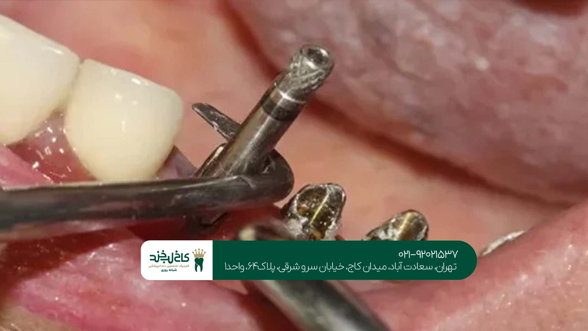ایمپلنت دیجیتال تهران ایمپلنت دیجیتال تهران