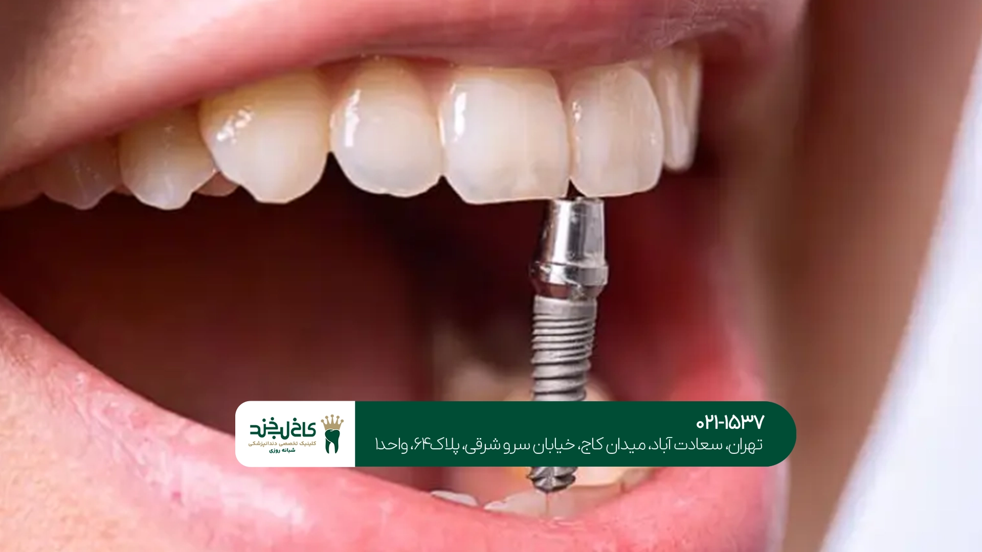 برند ایمپلنت دندان برند ایمپلنت دندان