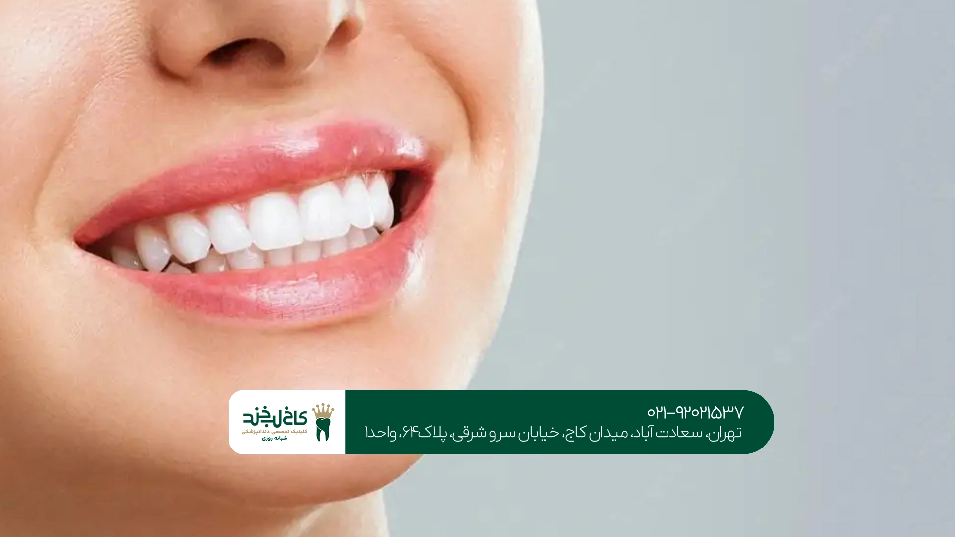 کامپوزیت دندان تهران کامپوزیت دندان تهران