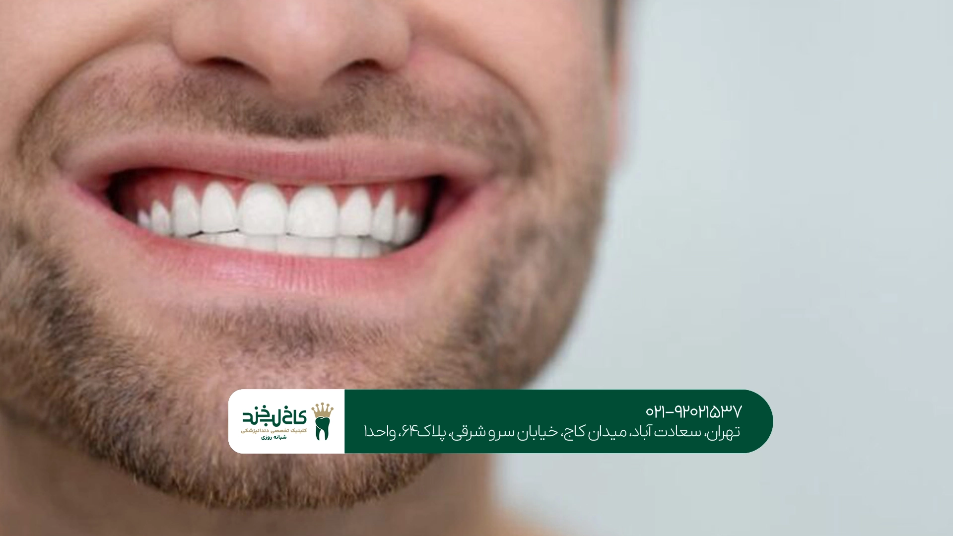 تفاوت برندهای مختلف کامپوزیت دندان تفاوت برندهای مختلف کامپوزیت دندان