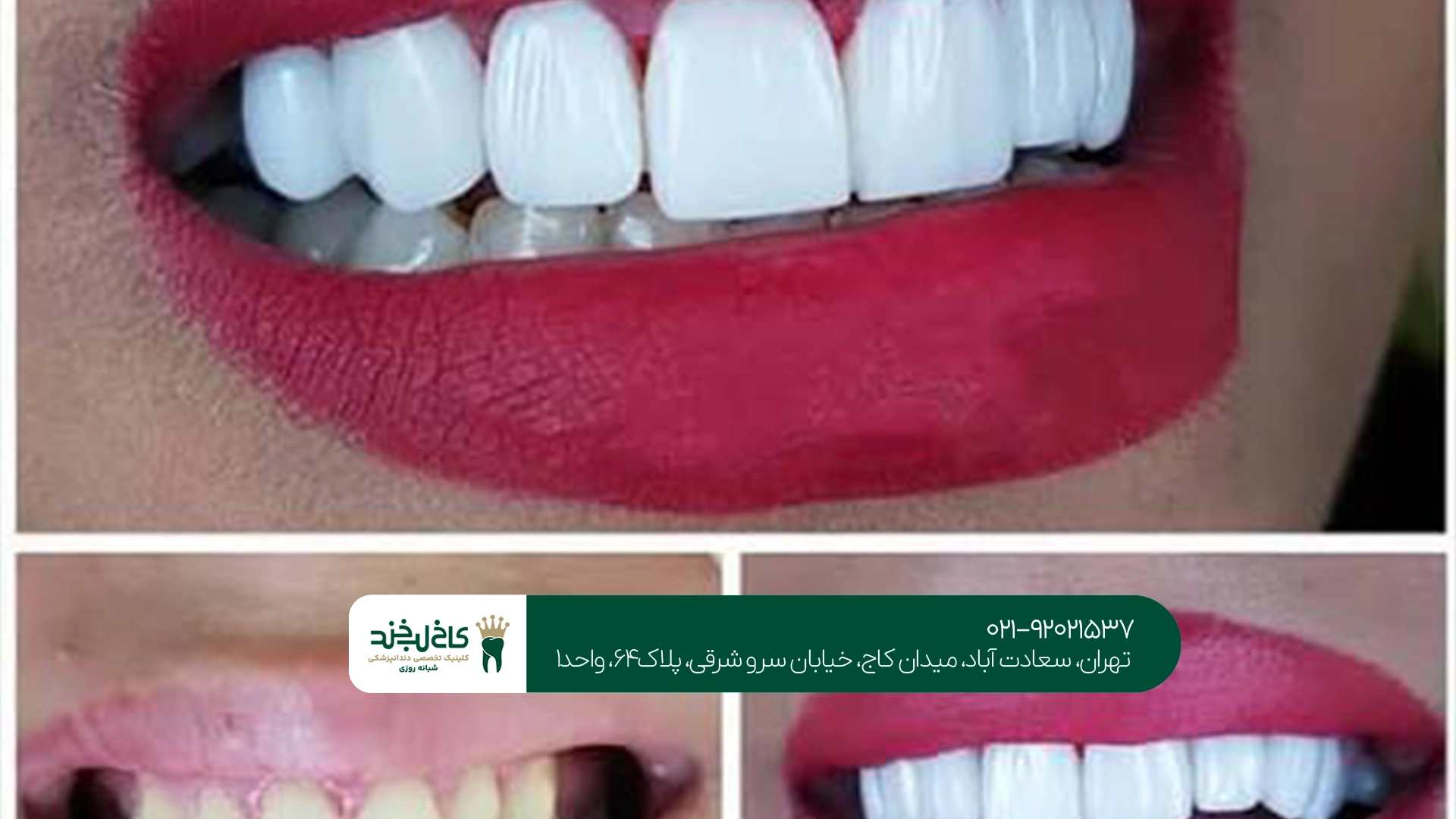 قیمت بهترین برند کامپوزیت دندان