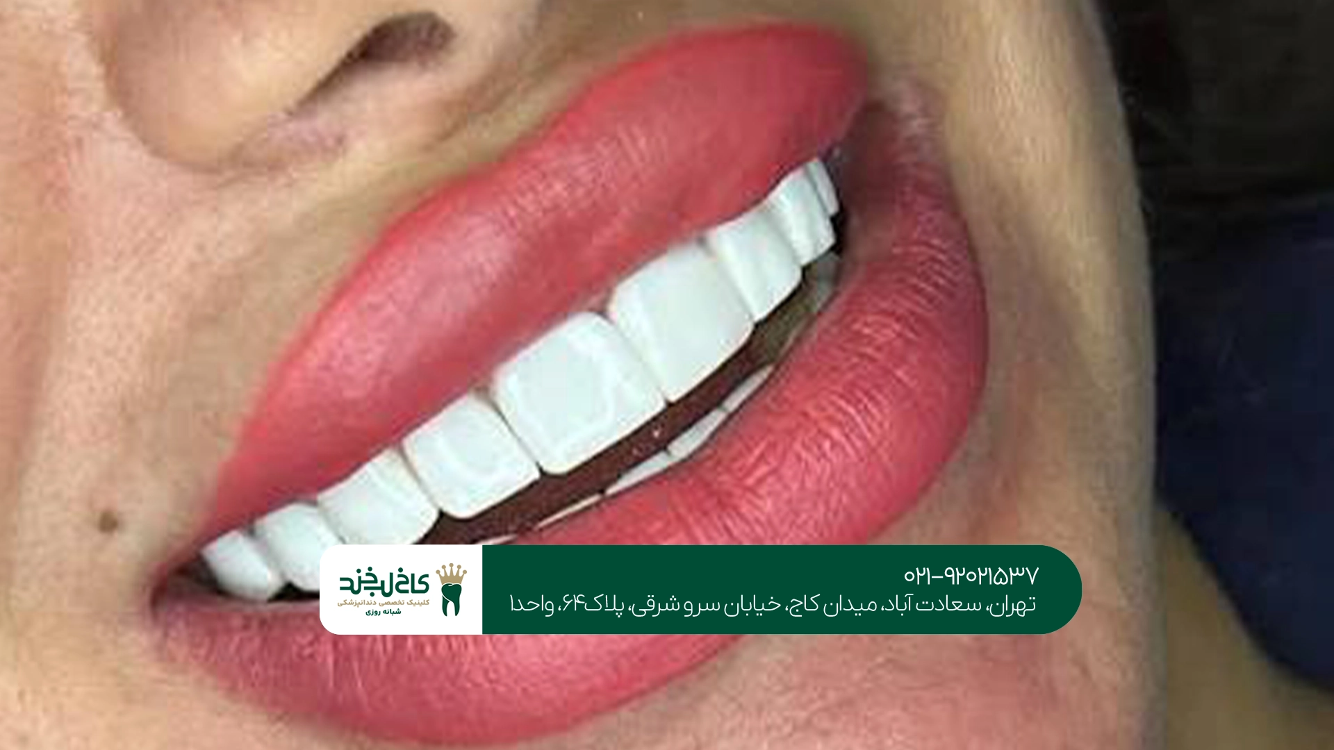 بهترین کلینیک برای کامپوزیت دندان