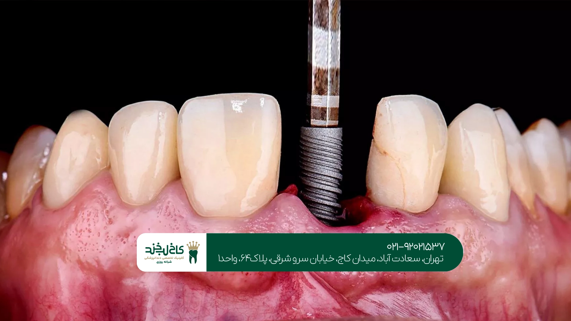 بهترین مرکز ایمپلنت زیر نظر متخصص
