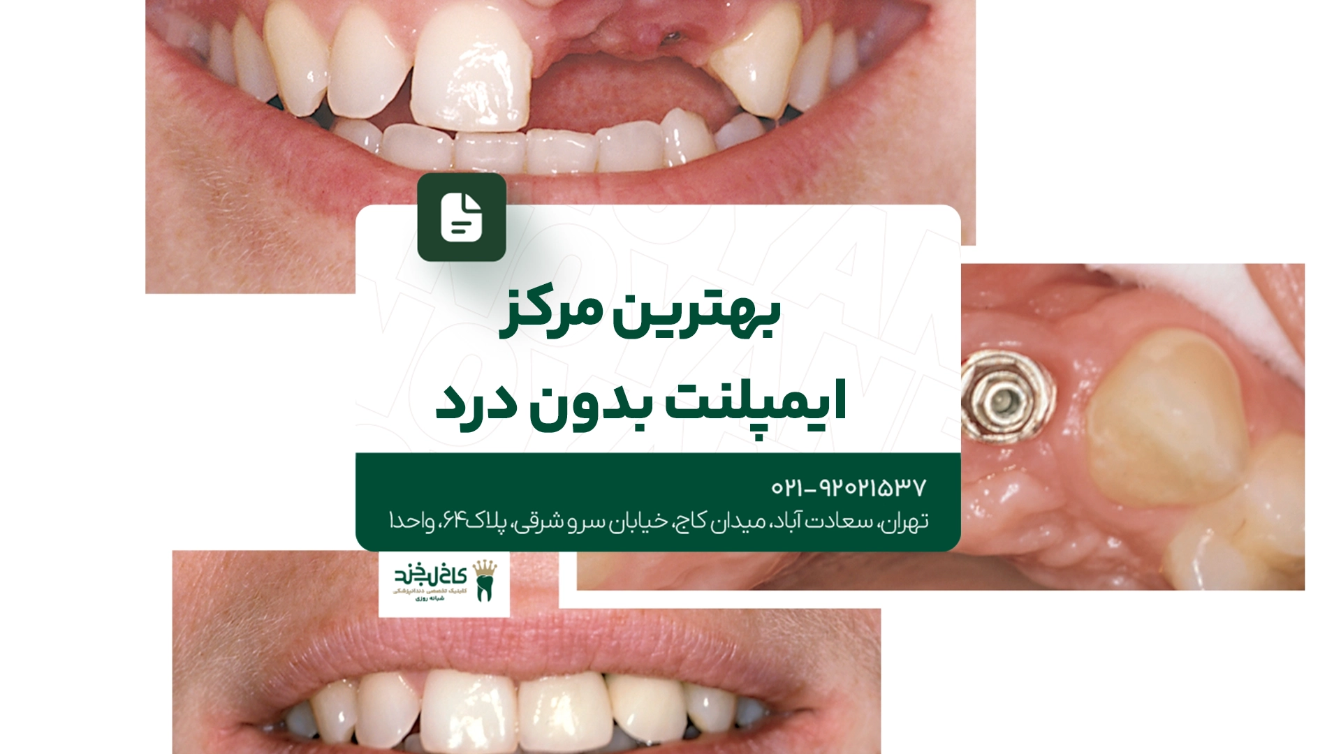 بهترین مرکز ایمپلنت بدون درد