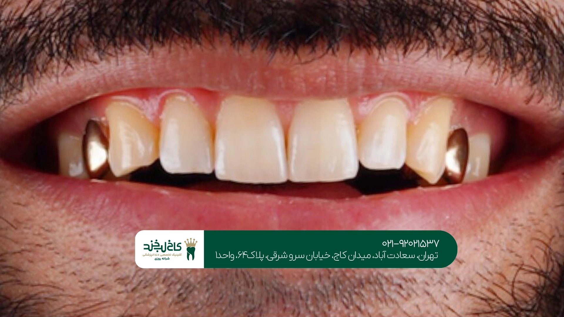 ایمپلنت دندان بدون درد تهران