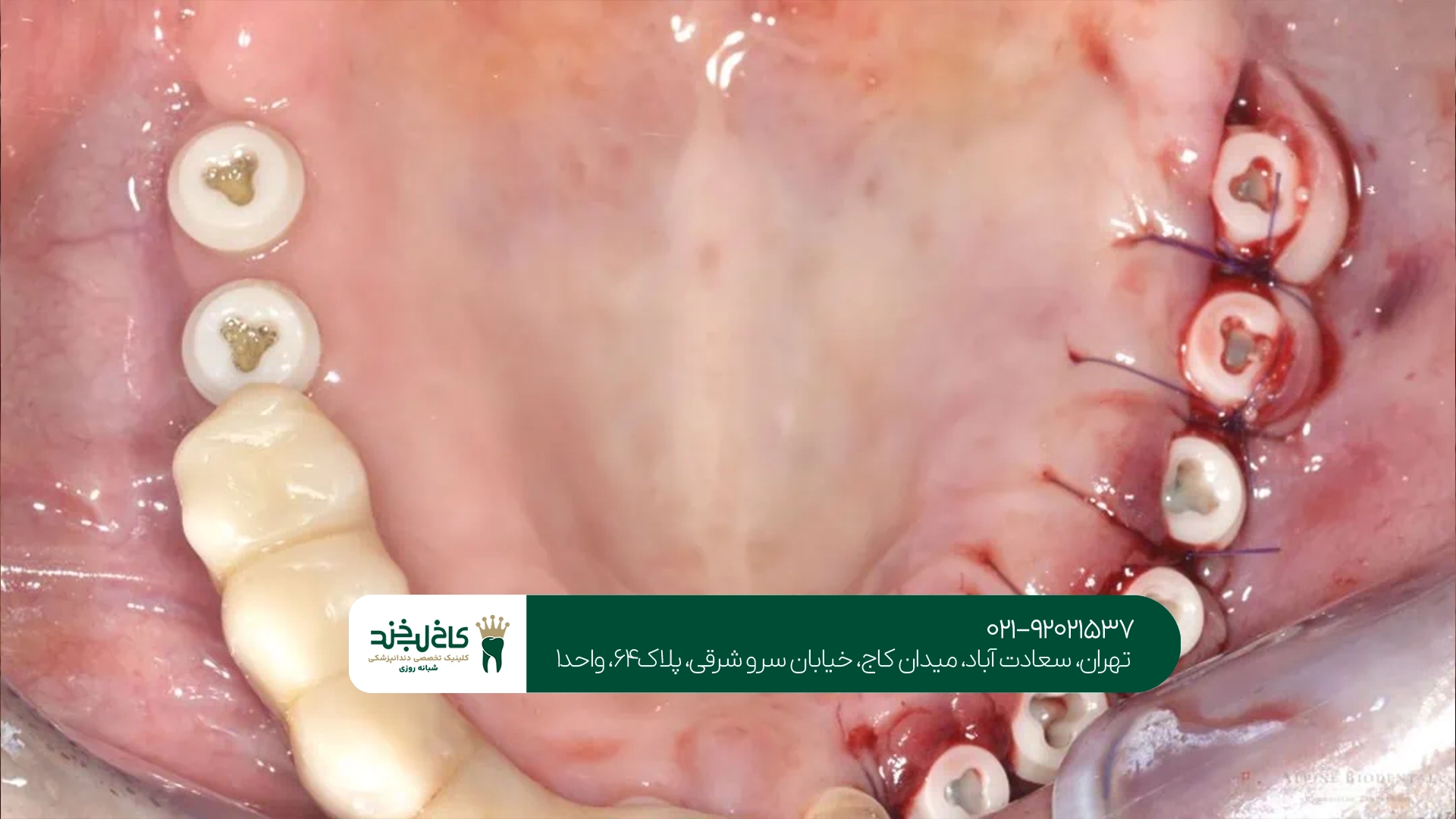 هزینه ایمپلنت بدون درد به چه عواملی بستگی دارد؟