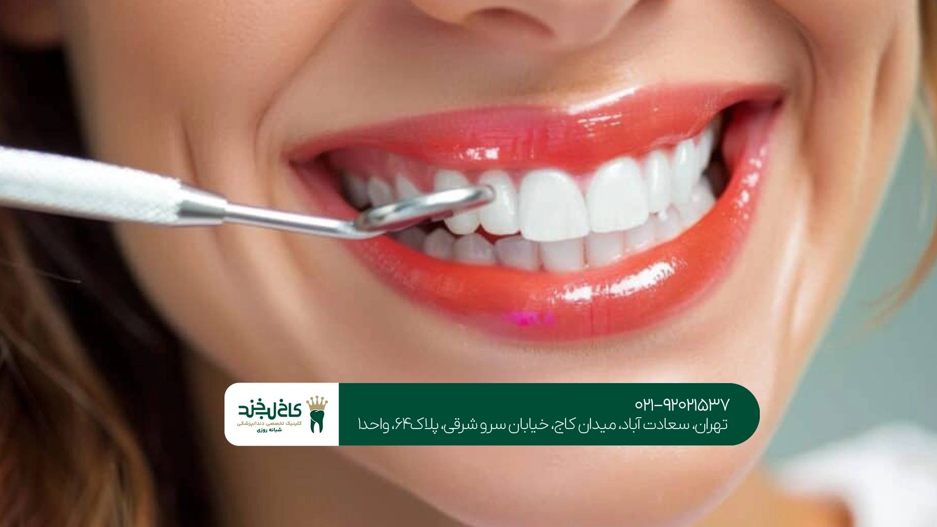 کامپوزیت بهتر است یا لمینت برای زیبایی دندان؟