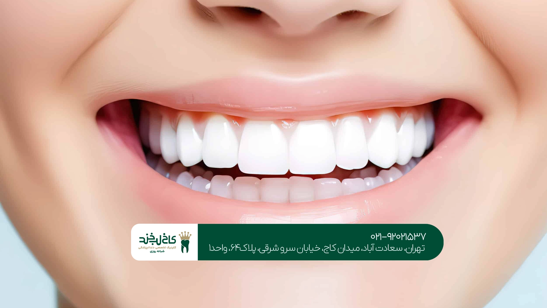 بهترین نوع زیبایی دندان برای تغییر رنگ دندان