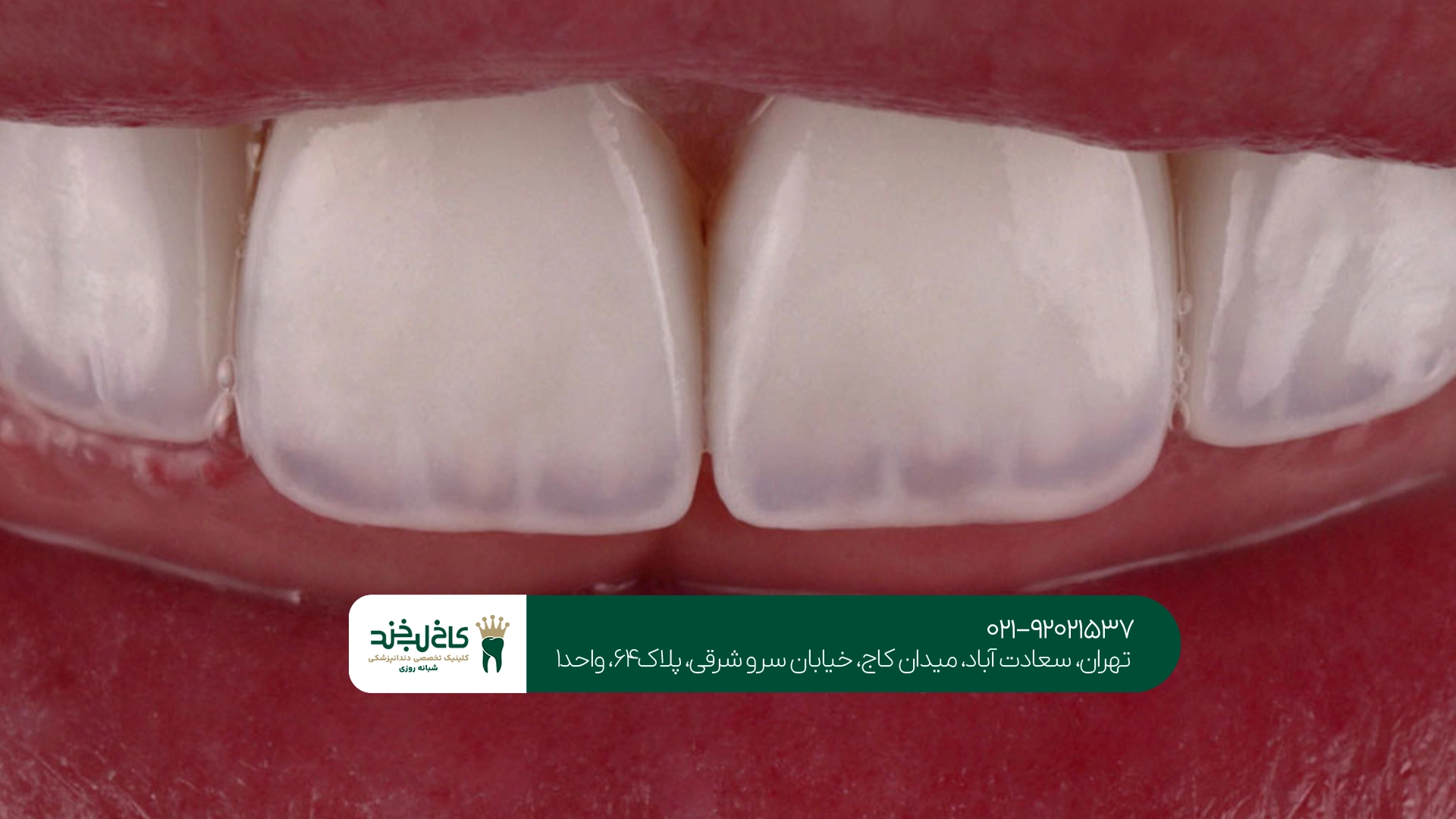 بهترین کامپوزیت دندان چه ماندگاری دارد؟