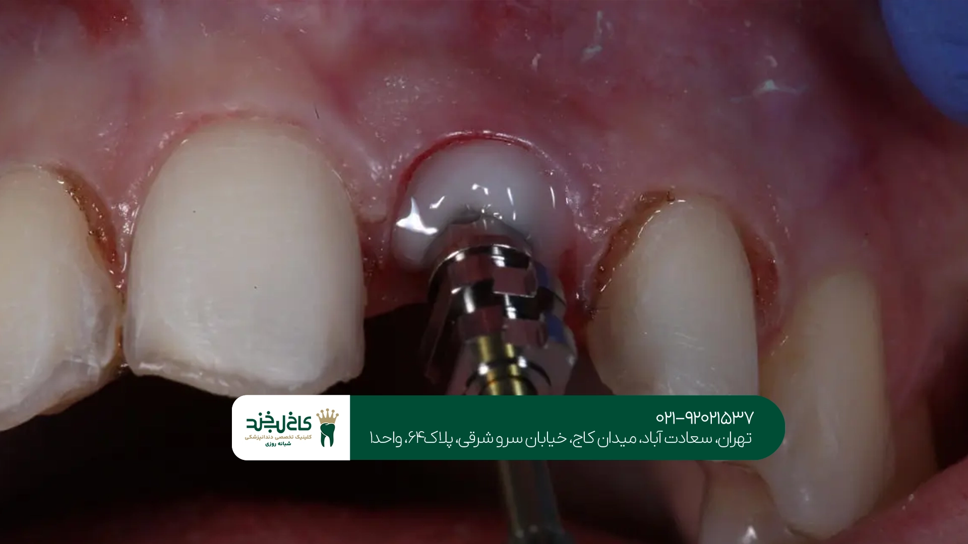 ایمپلنت دیجیتال ایمپلنت دیجیتال
