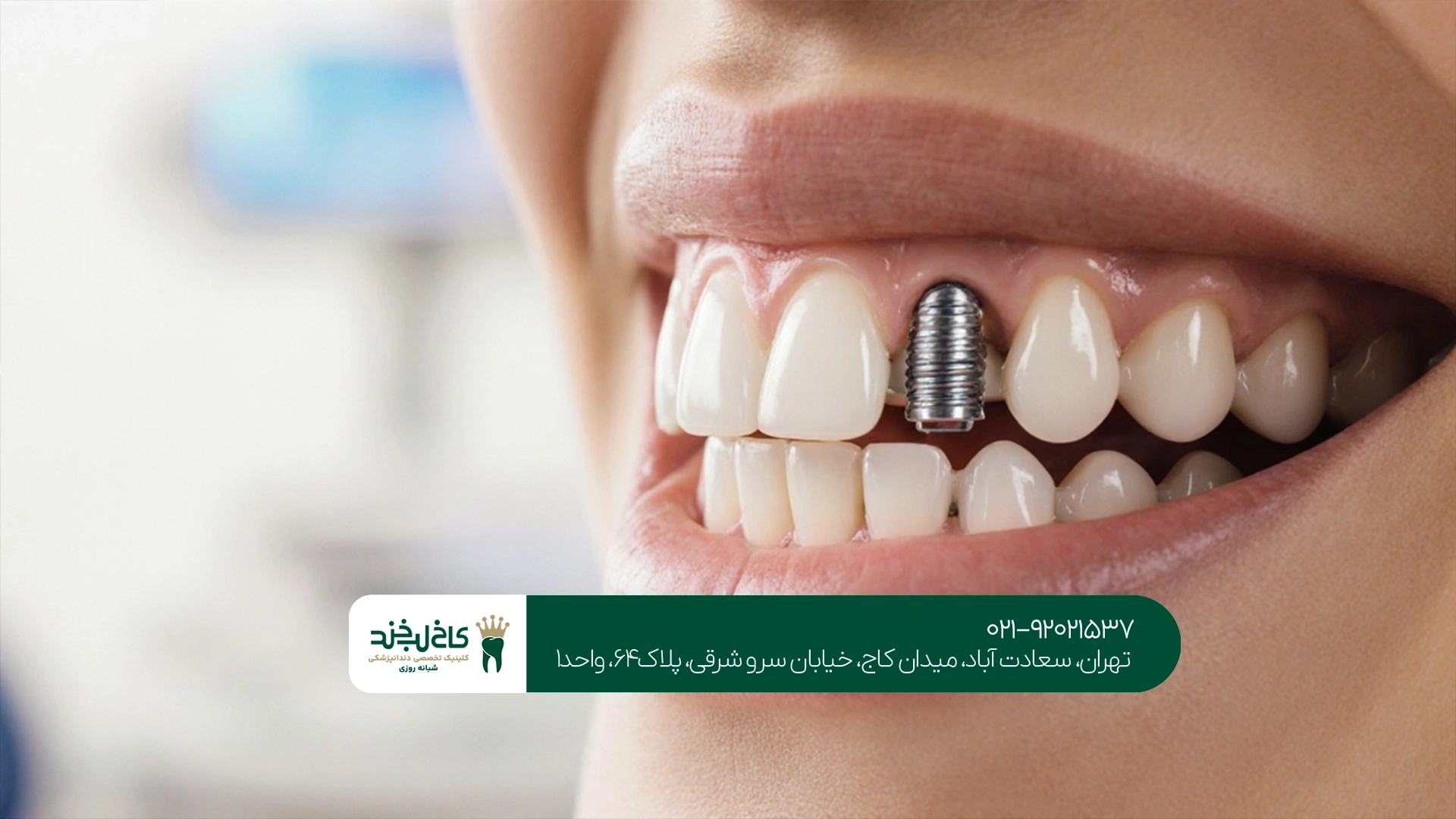 چگونه بهترین کلینیک ایمپلنت تهران را انتخاب کنیم؟
