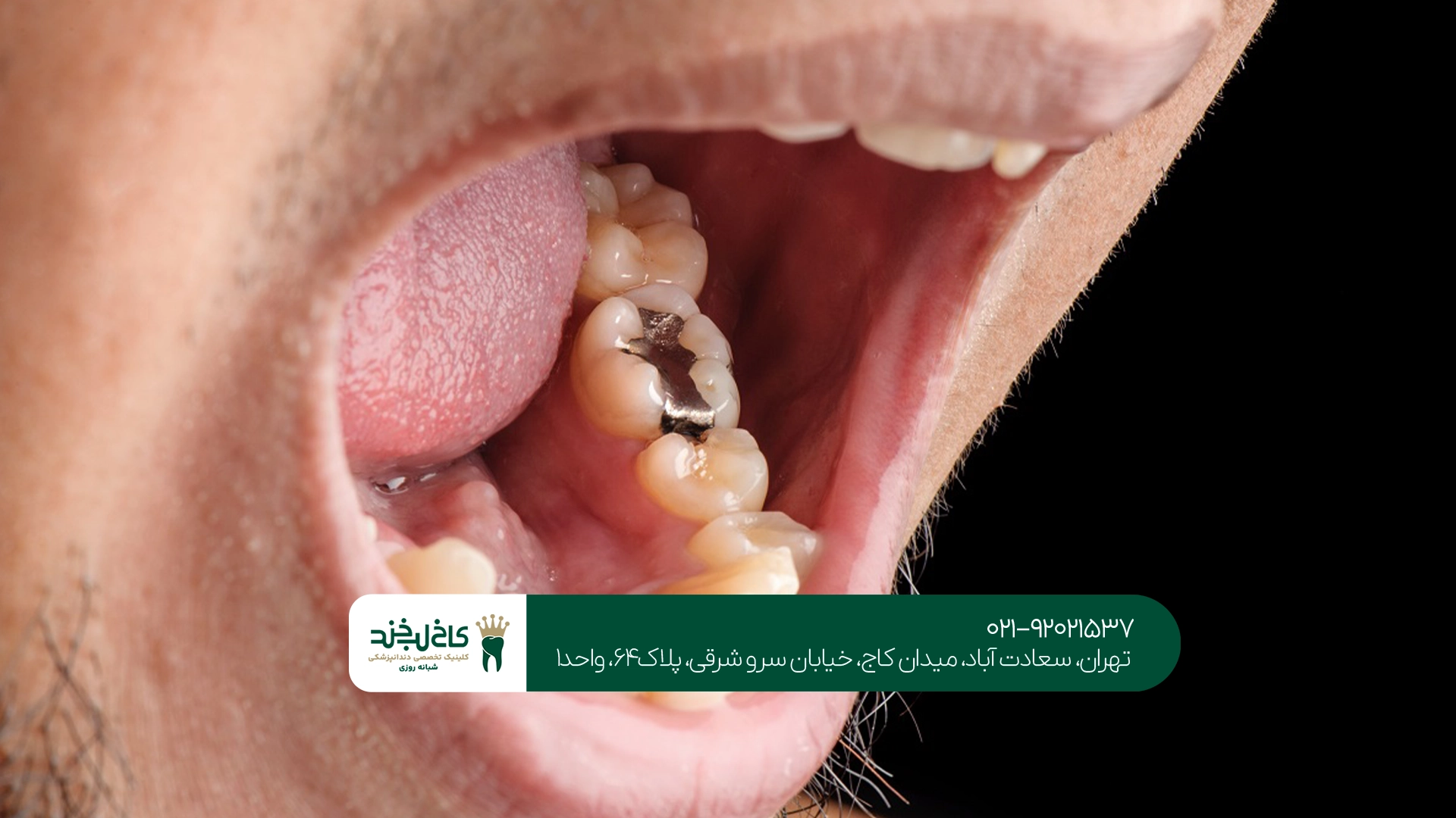 ترمیم دندان چیست؟ ترمیم دندان چیست؟