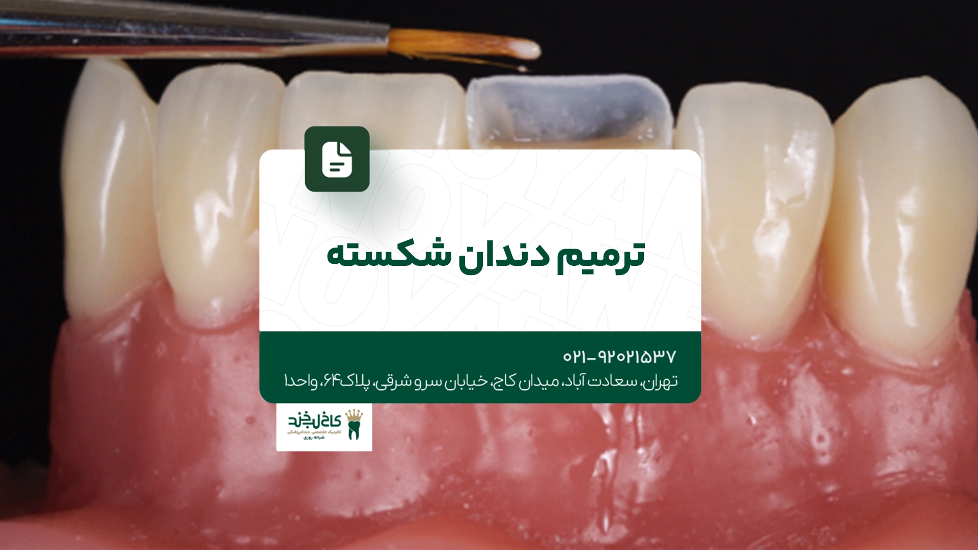 ترمیم دندان شکسته