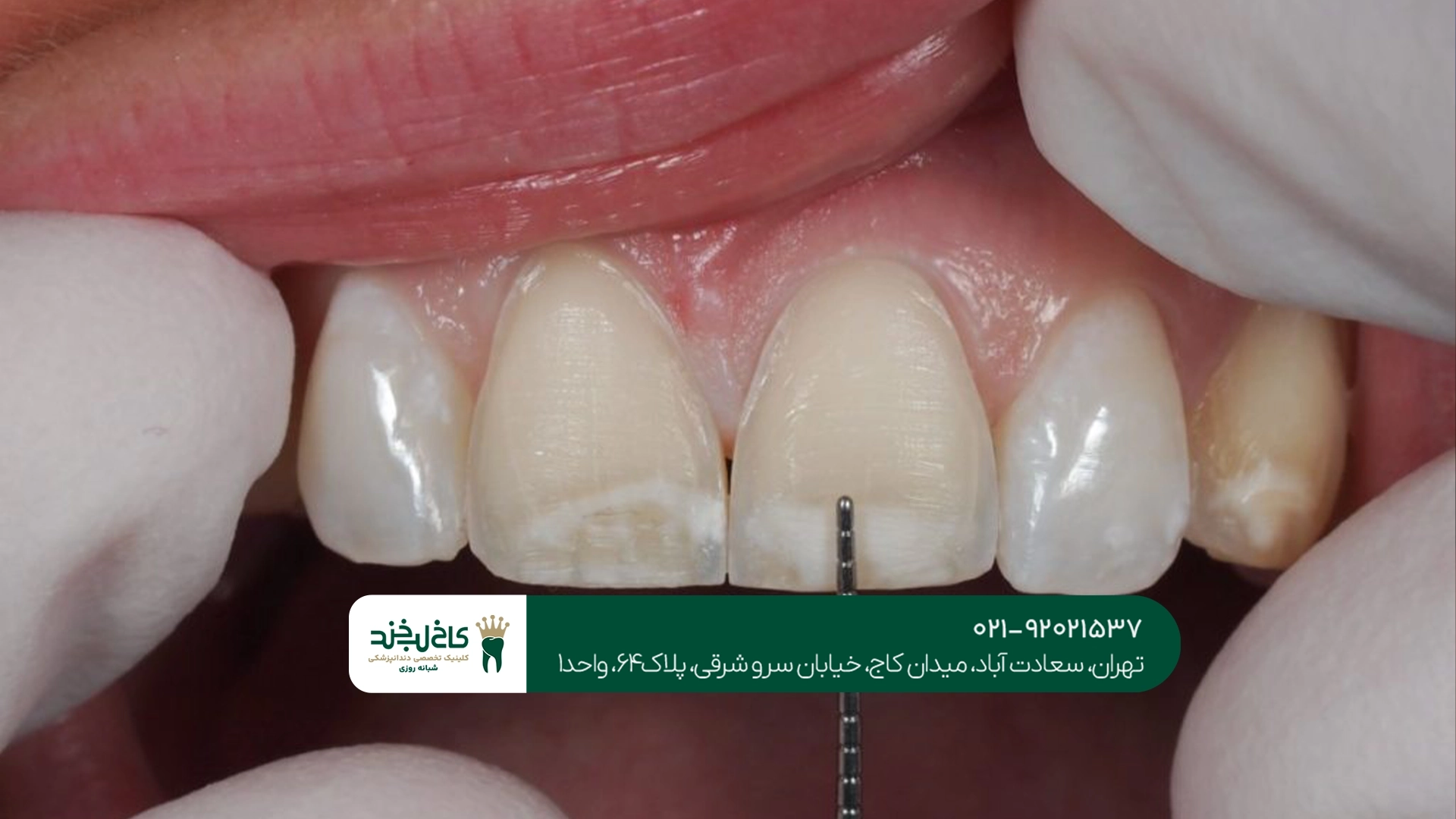 ترمیم دندان شکسته با کامپوزیت
