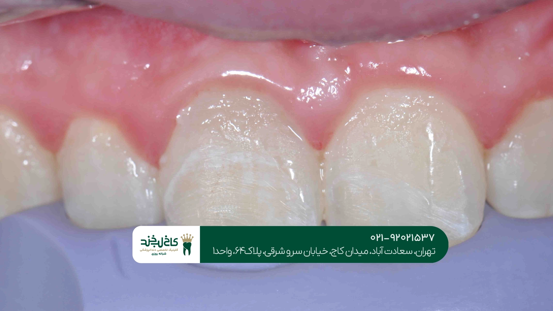 ترمیم دندان شکسته در تهران