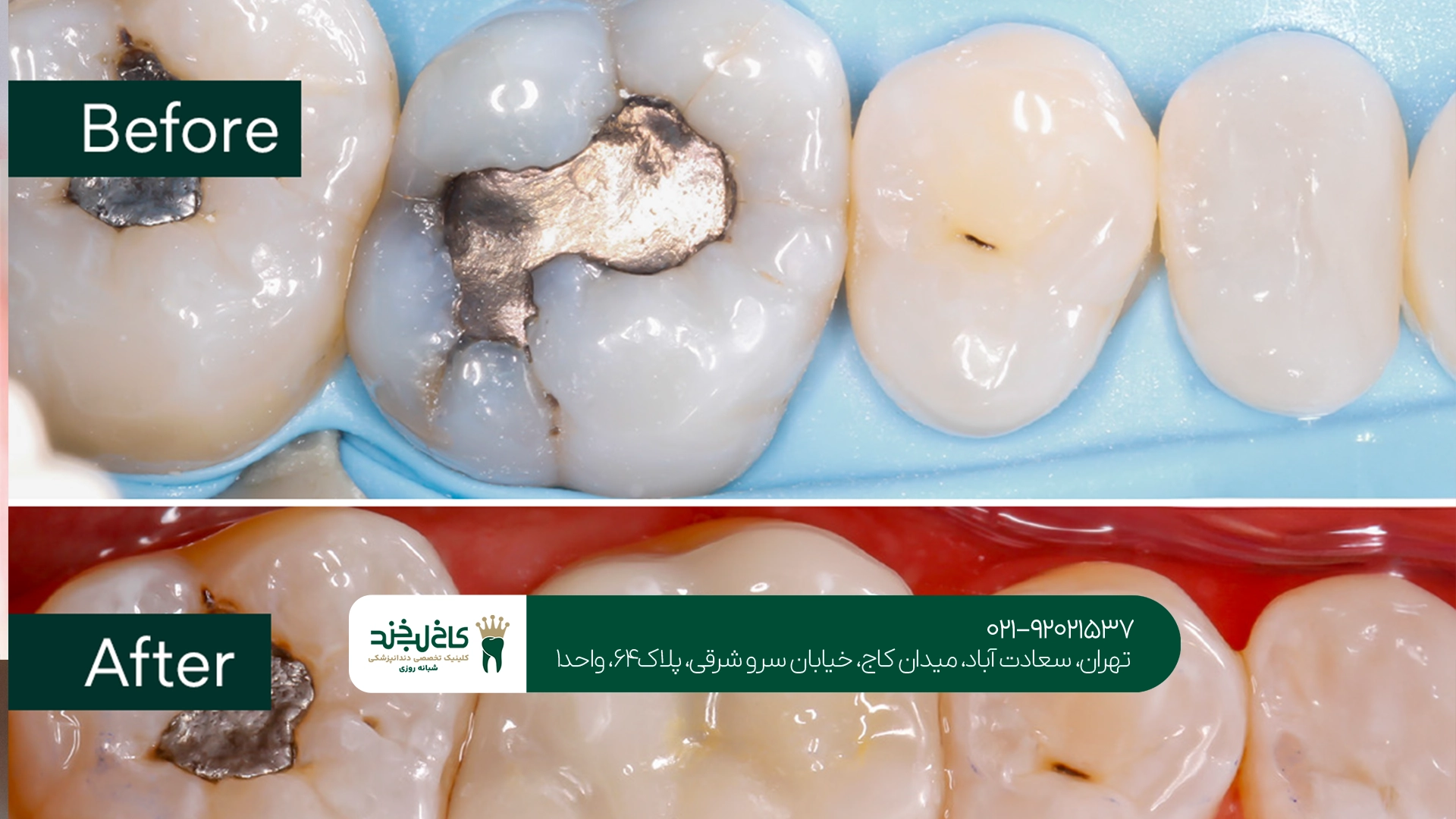 چه علائمی نشان میدهد دندان به ترمیم نیاز دارد؟ چه علائمی نشان میدهد دندان به ترمیم نیاز دارد؟
