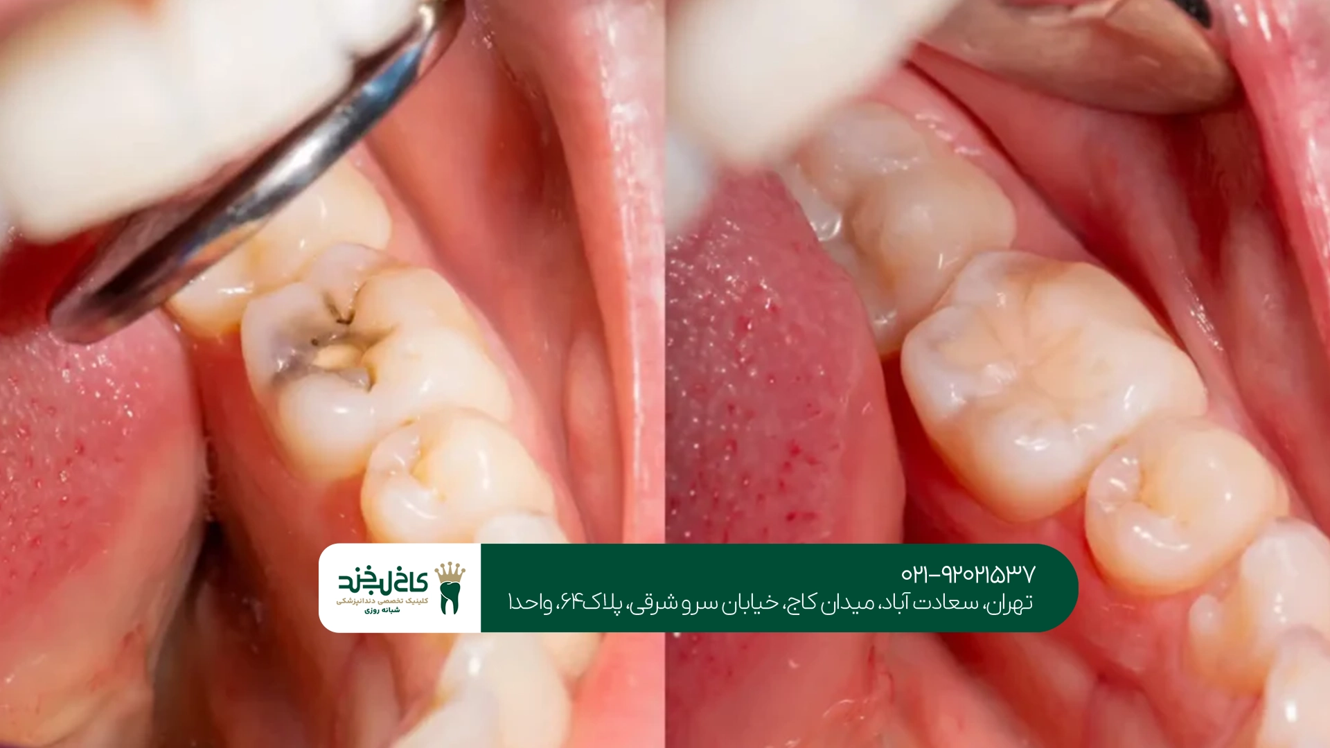 انواع روشهای ترمیم دندان انواع روشهای ترمیم دندان