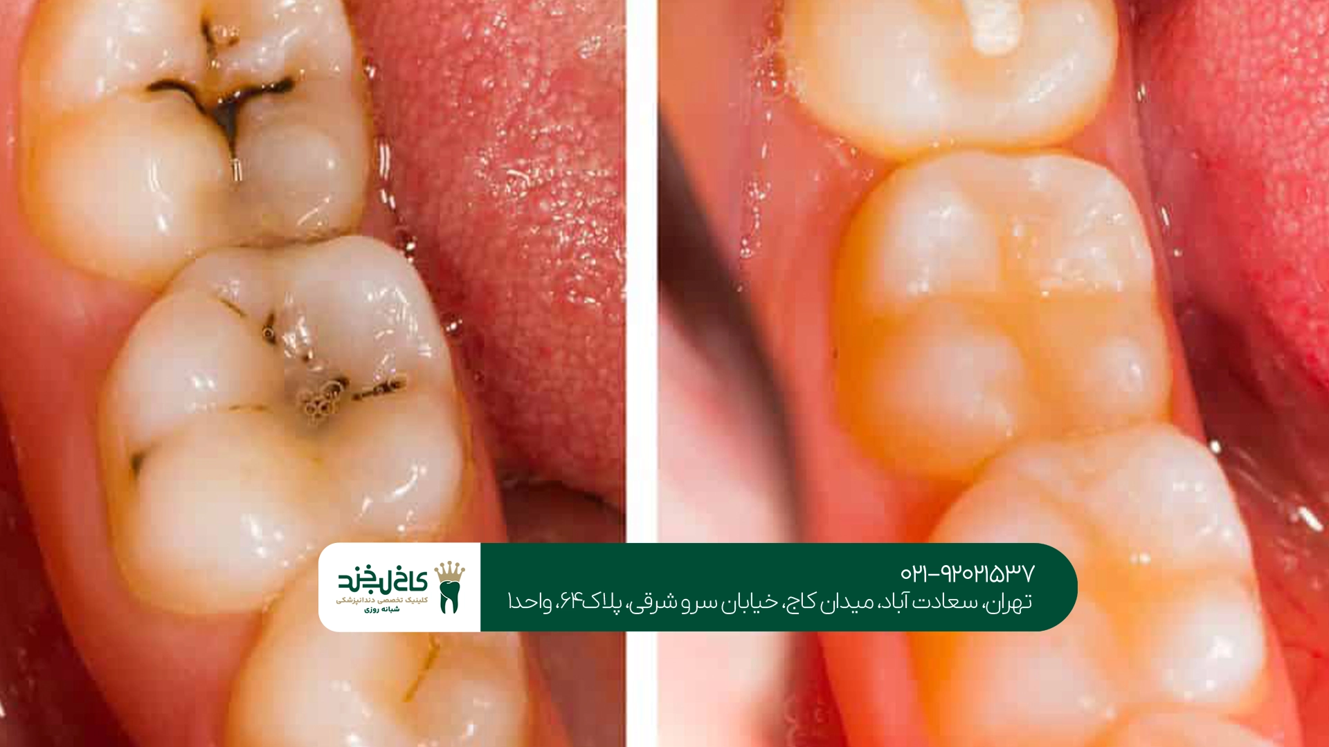 ترمیم دندانهای عقبی ترمیم دندانهای عقبی