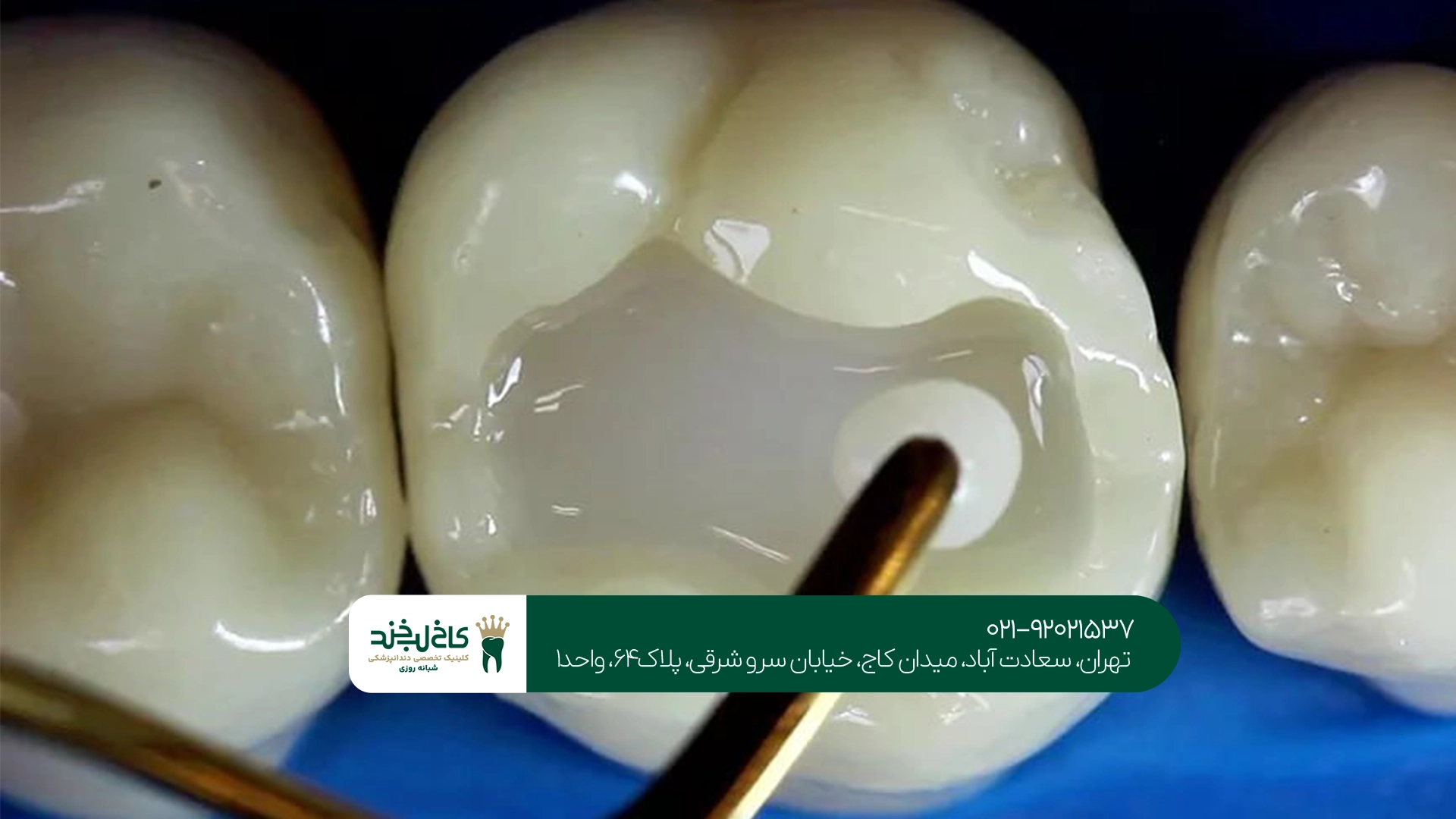 ترمیم دندان چقدر دوام دارد؟ ترمیم دندان چقدر دوام دارد؟