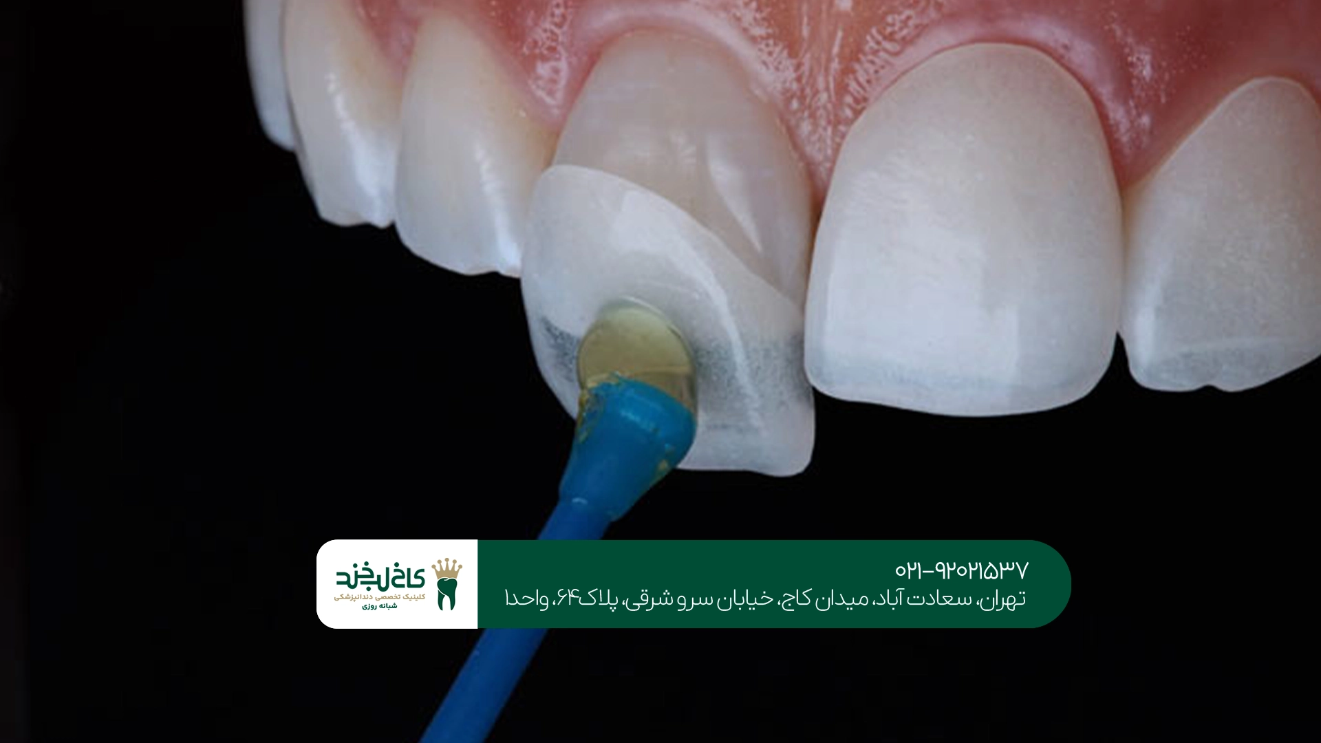 ترمیم دندان شکسته و لبپریده