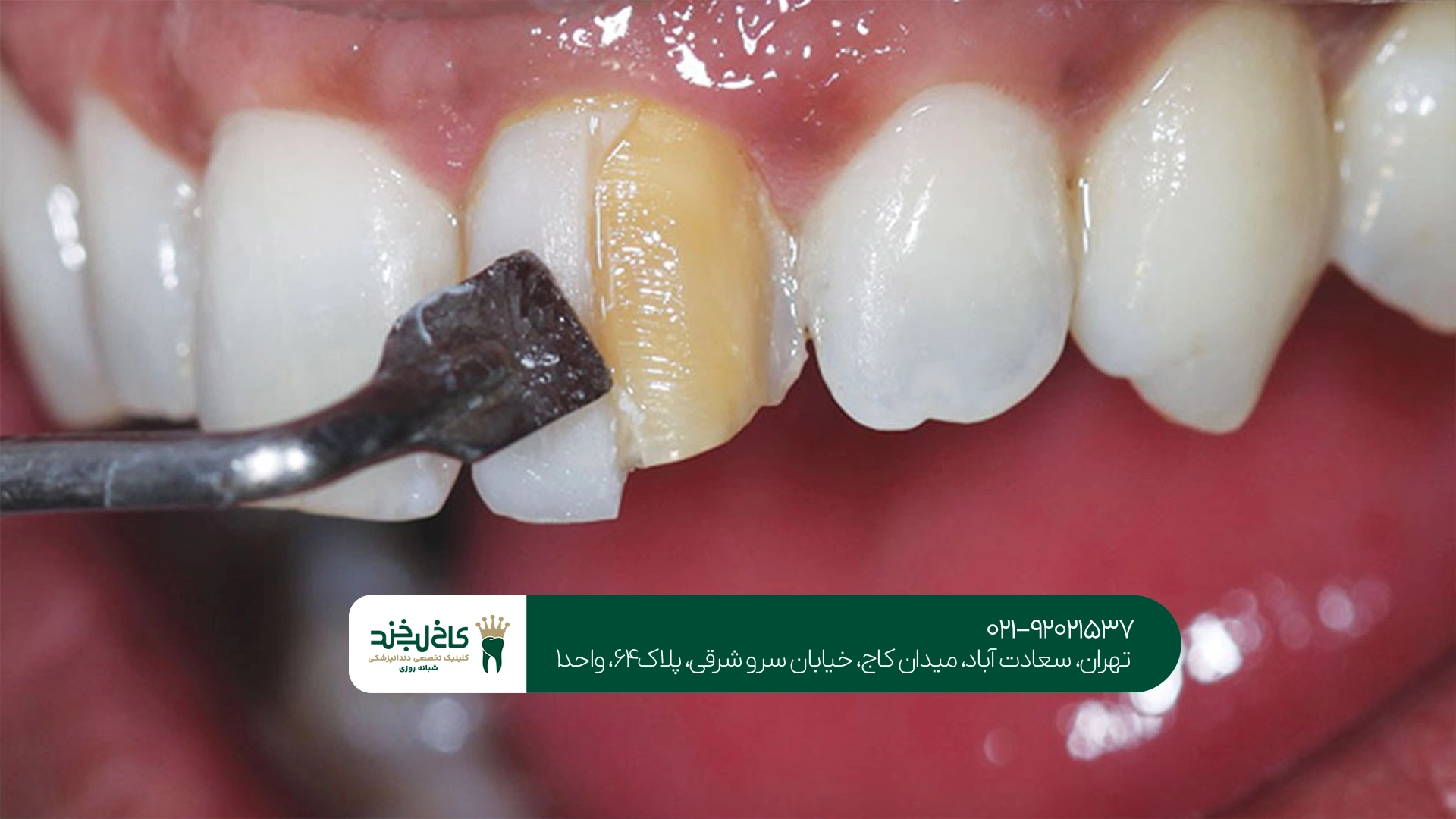ترمیم زیبایی دندان در تهران