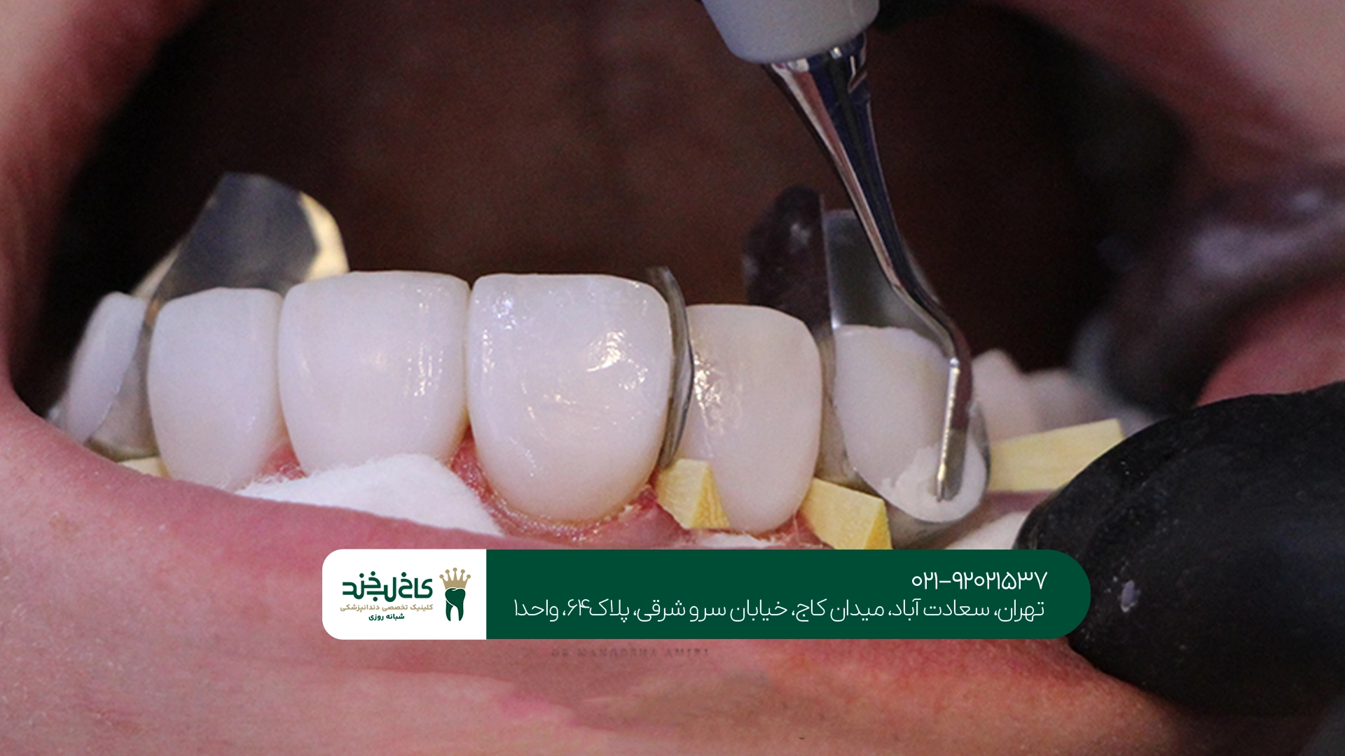 آیا روکش دندان شکسته قابل تعویض است؟