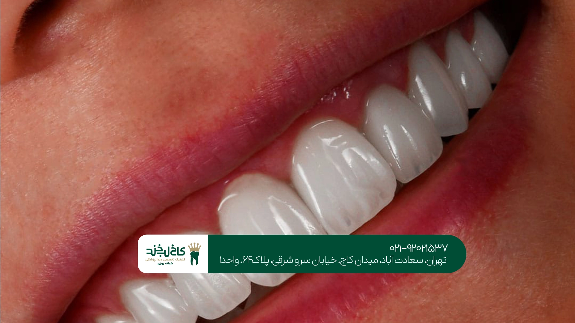 تعویض روکش دندان در تهران