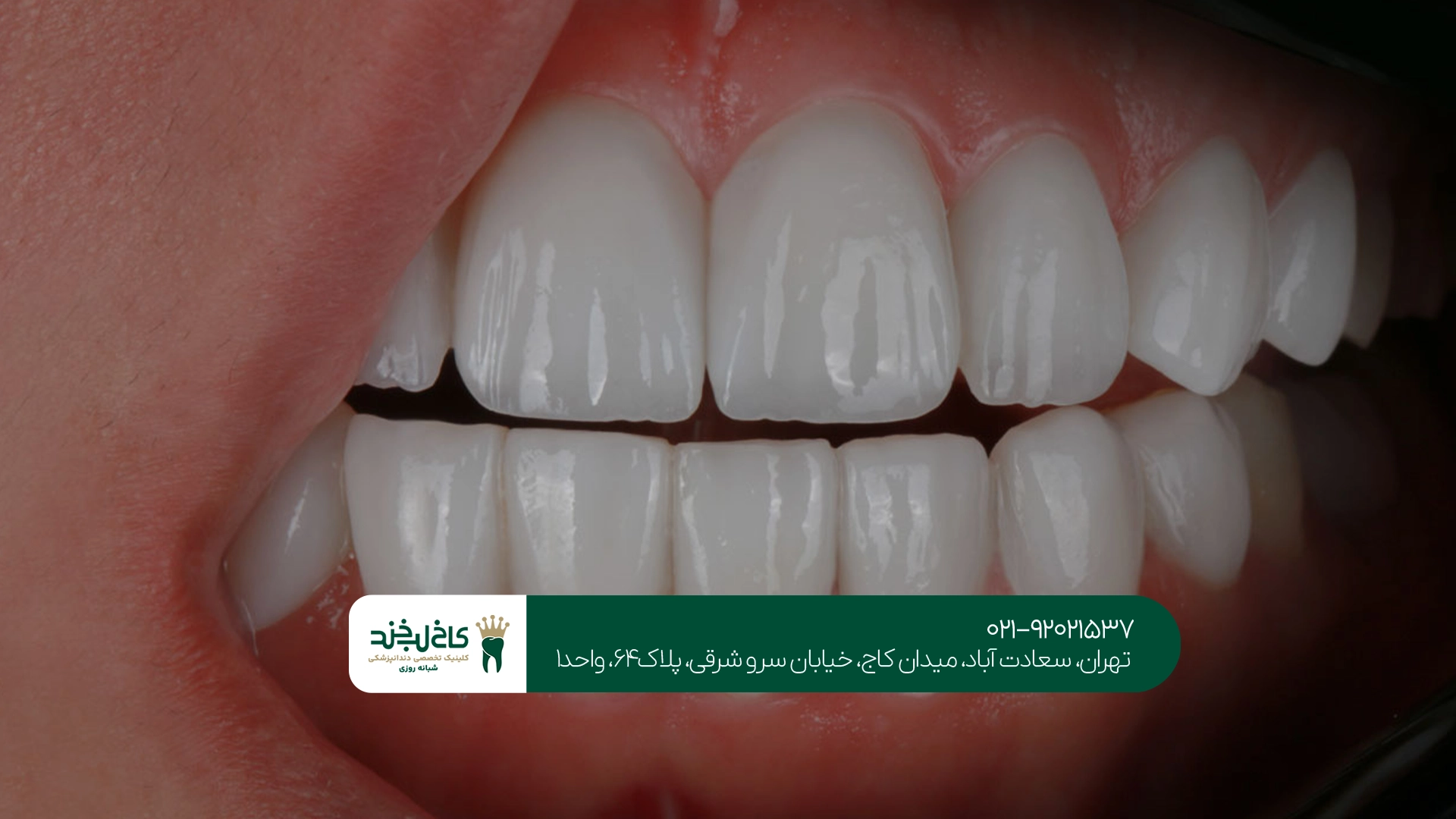 دندانپزشکی تعویض روکش دندان تهران