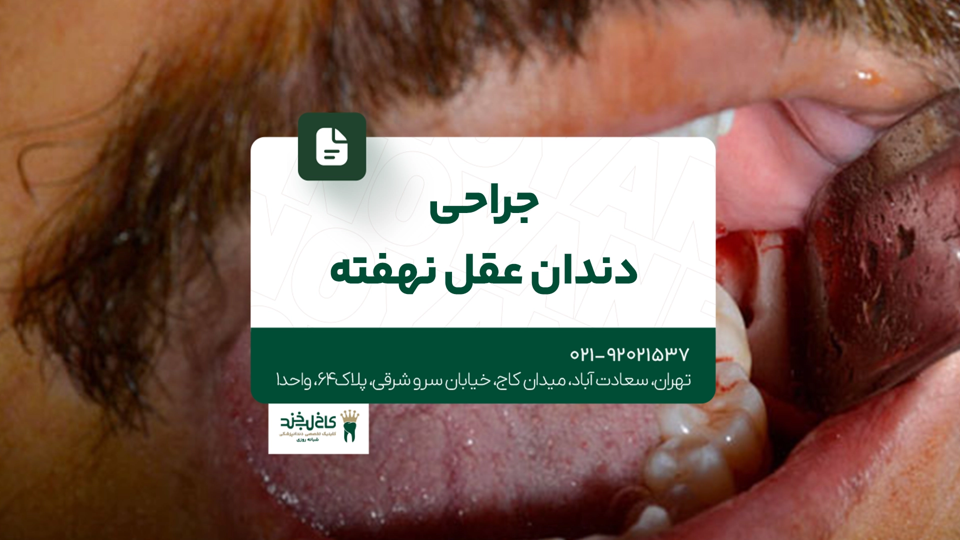 جراحی دندان عقل نهفته