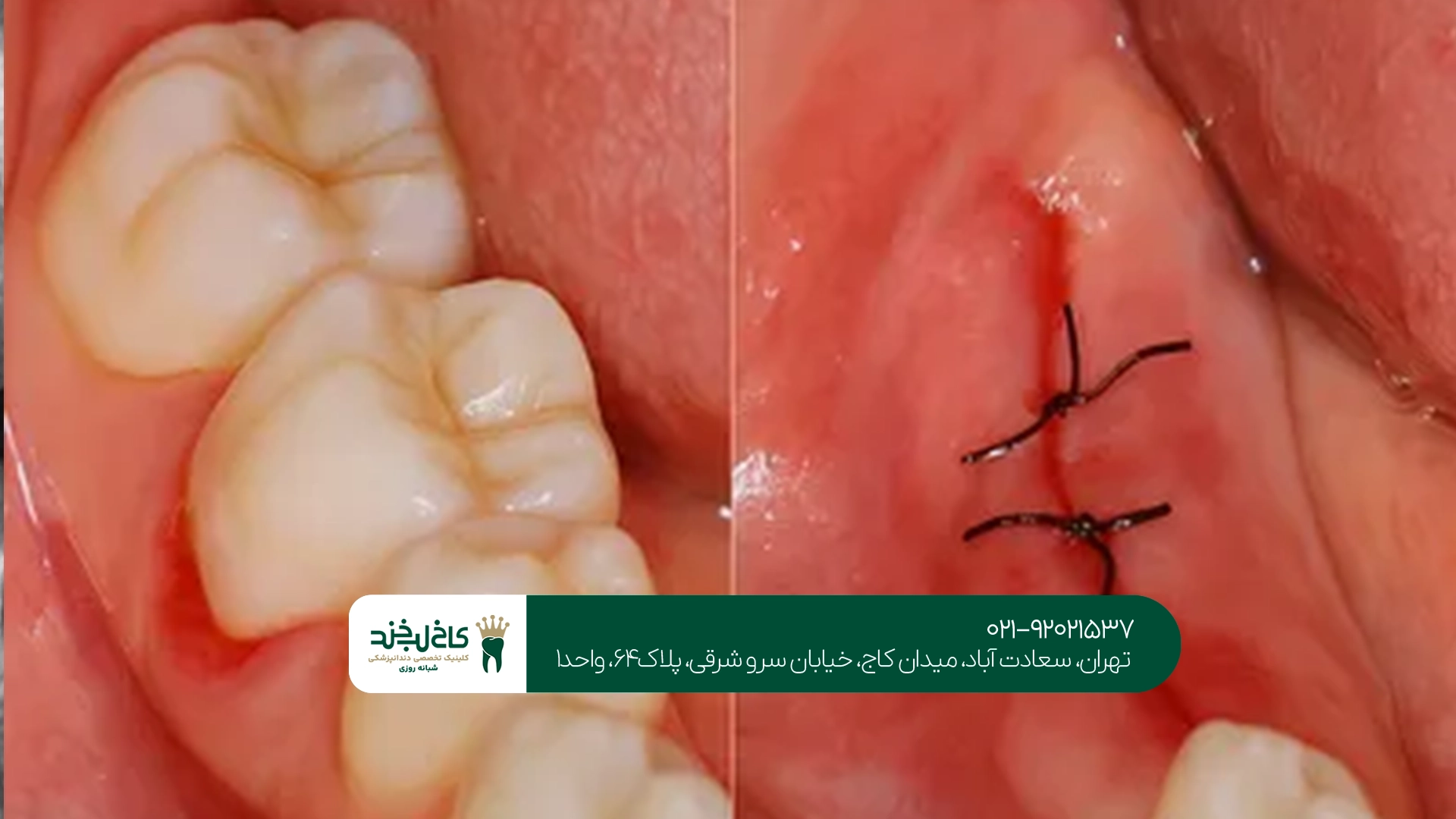 متخصص دندان عقل تهران