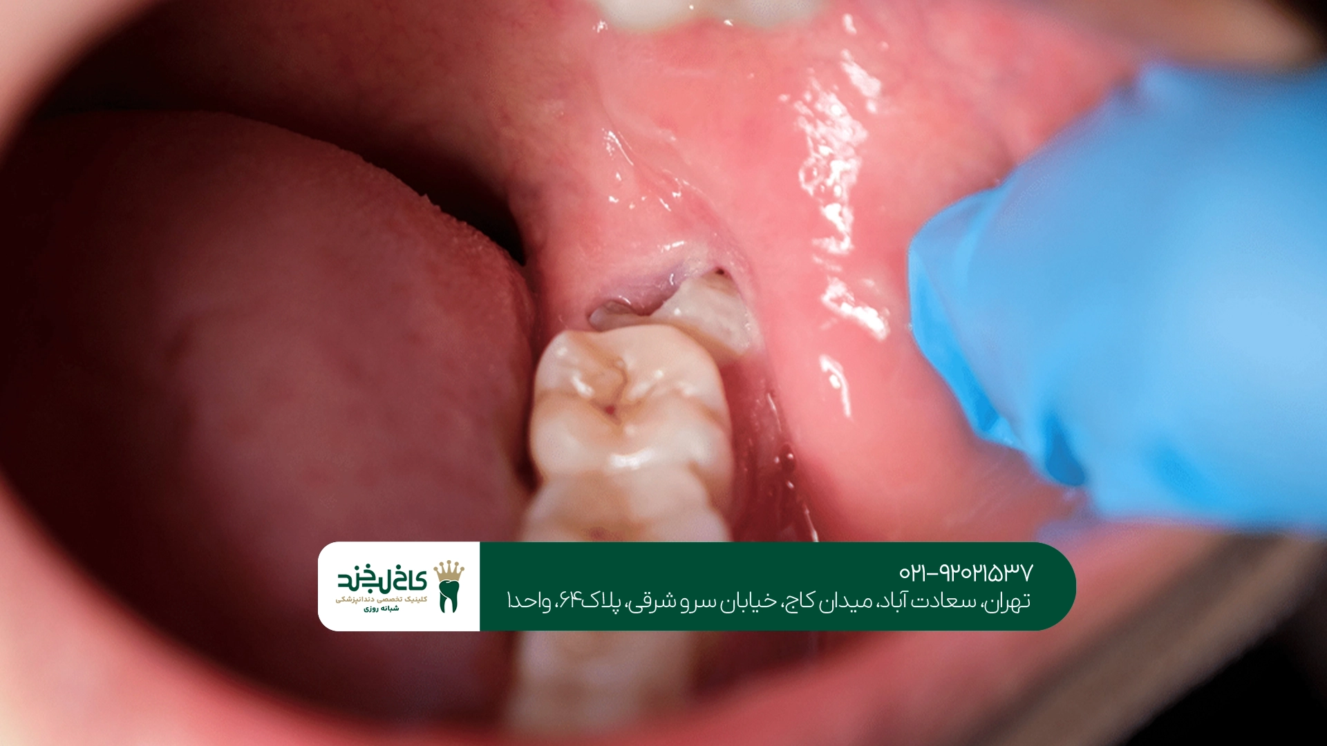 عوارض جراحی دندان عقل نهفته چیست؟