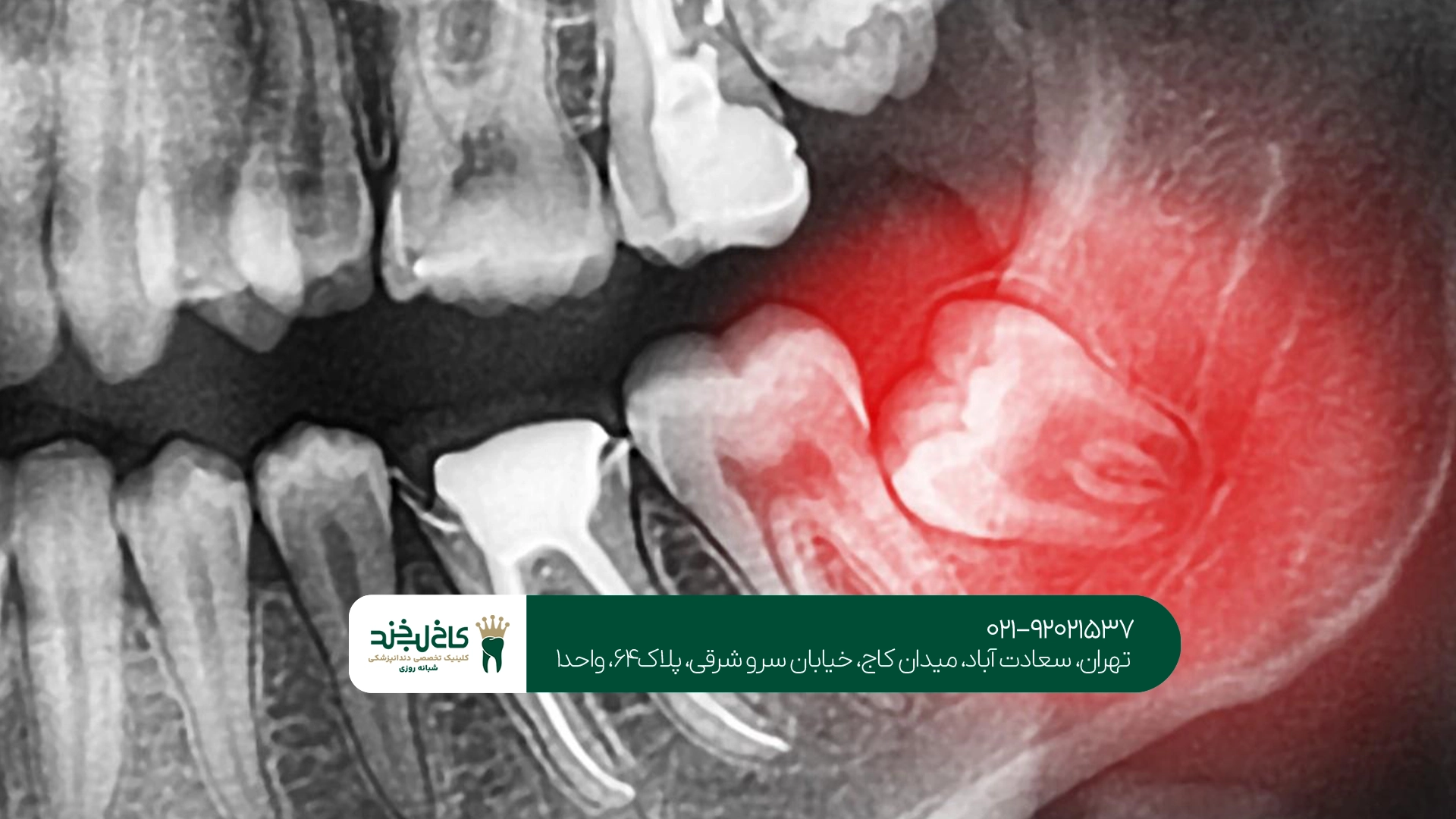 مراقبتهای بعد از جراحی دندان عقل نهفته چیست؟