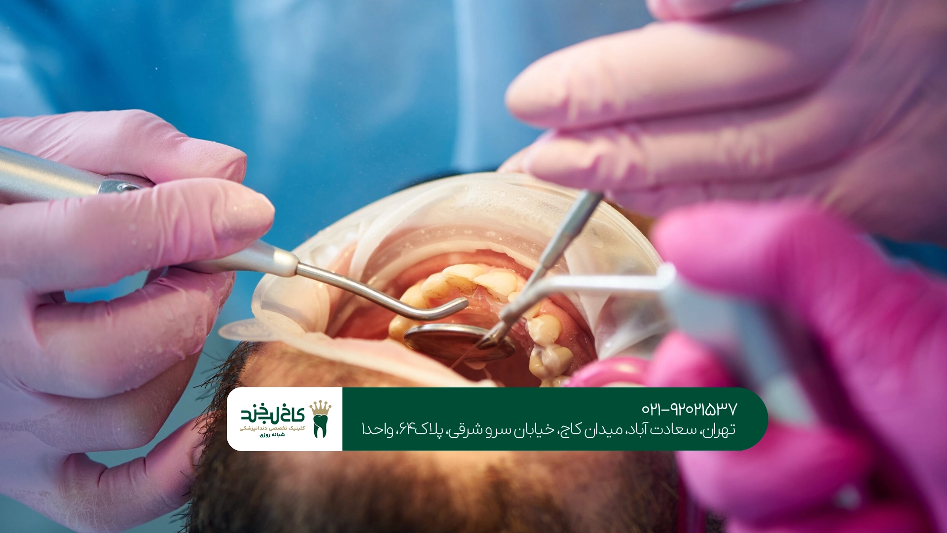 مرکز جراحی دندان عقل