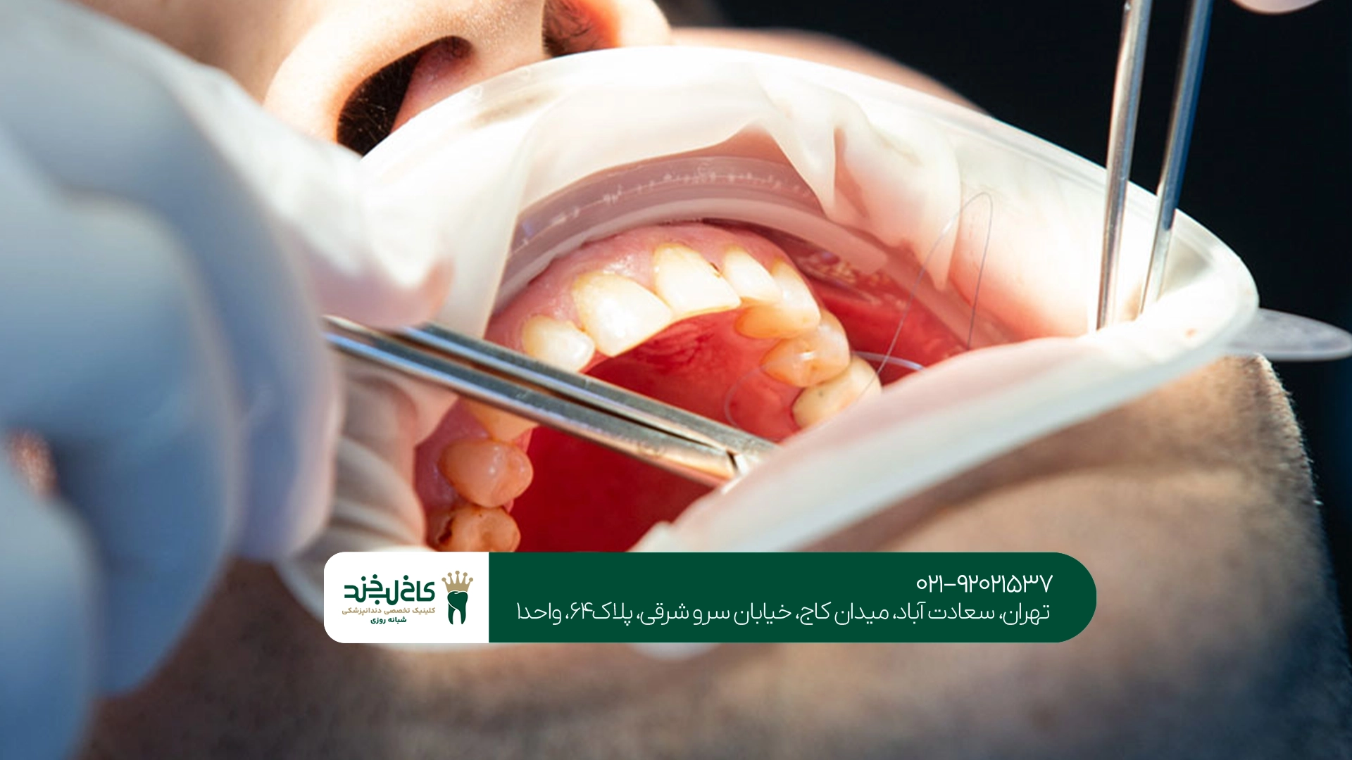 مراحل جراحی دندان عقل نهفته
