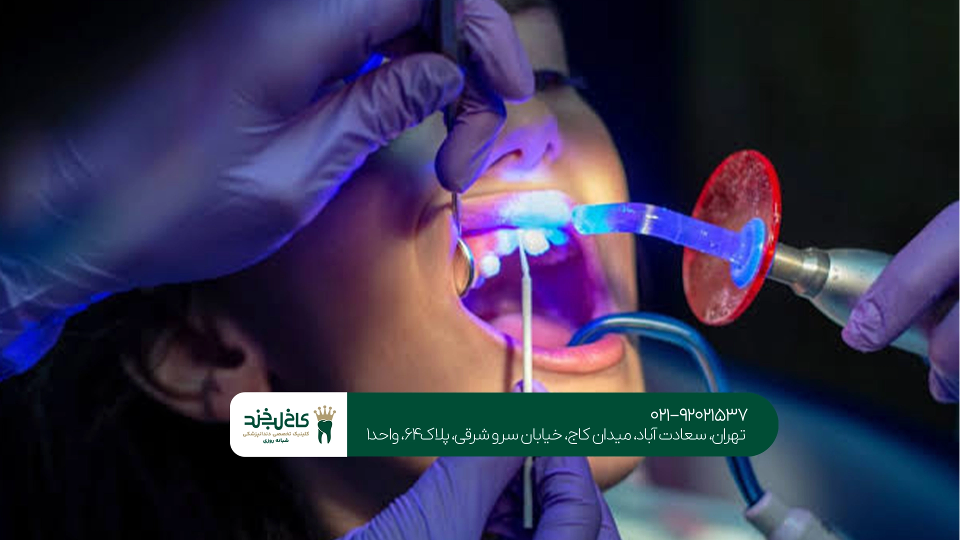 جراحی دندان لیزری در کاخ لبخند جراحی دندان لیزری در کاخ لبخند