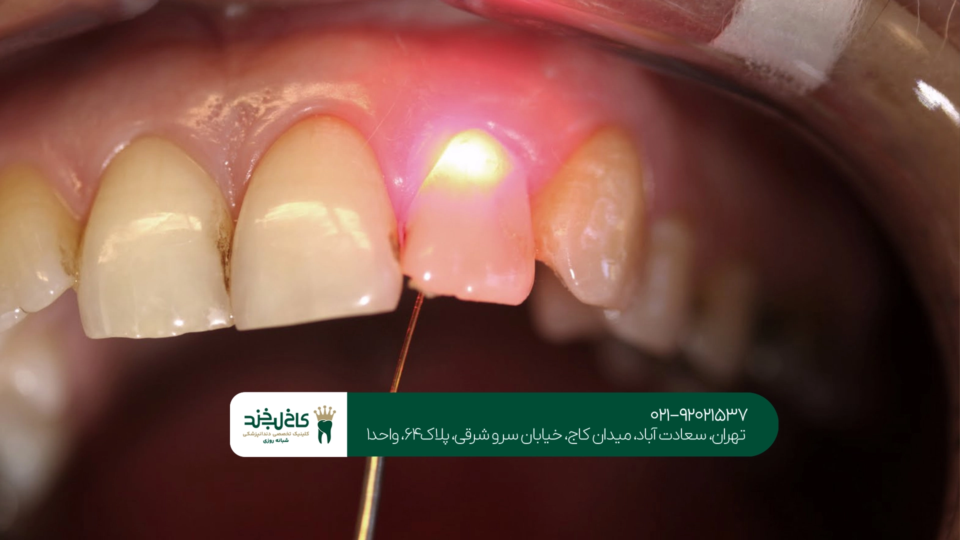 مرکز تخصصی جراحی لثه با لیزر تهران مرکز تخصصی جراحی لثه با لیزر تهران