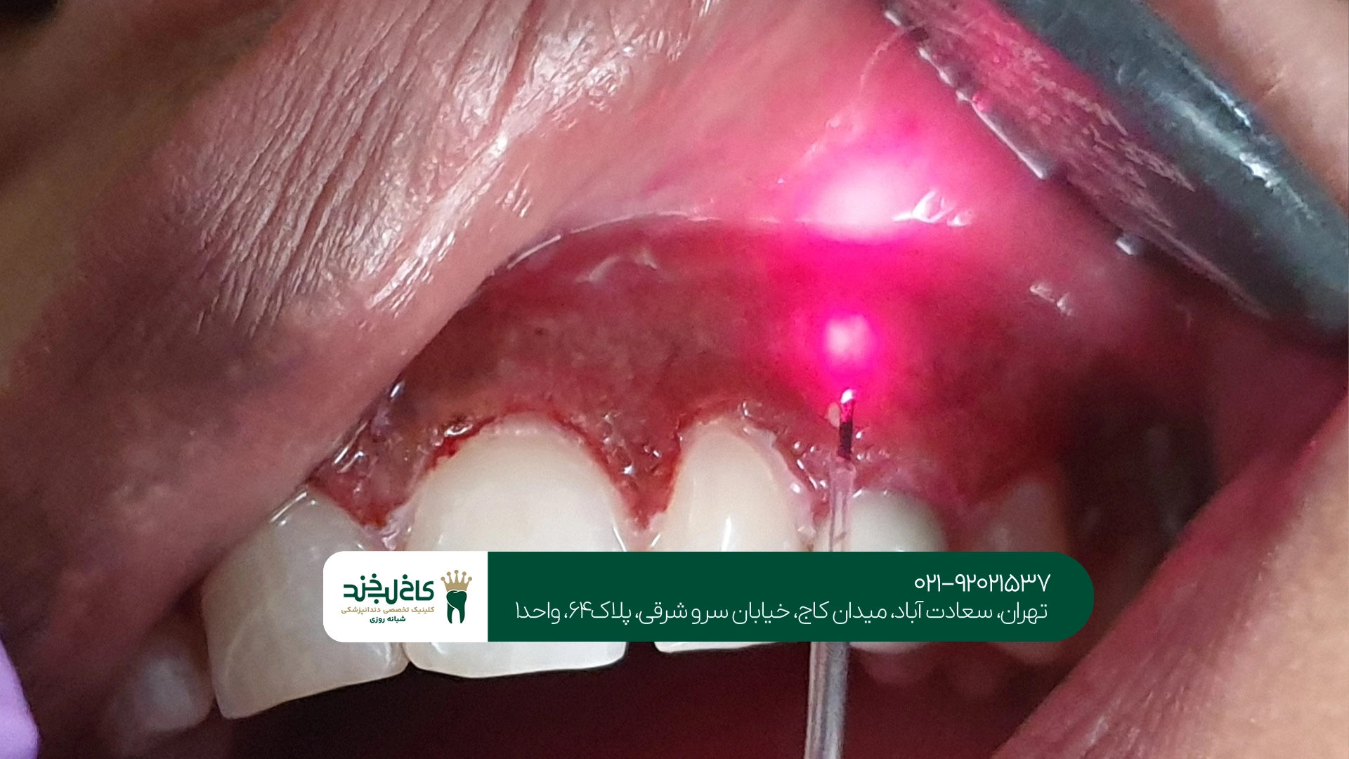 مزایای جراحی لثه مزایای جراحی لثه