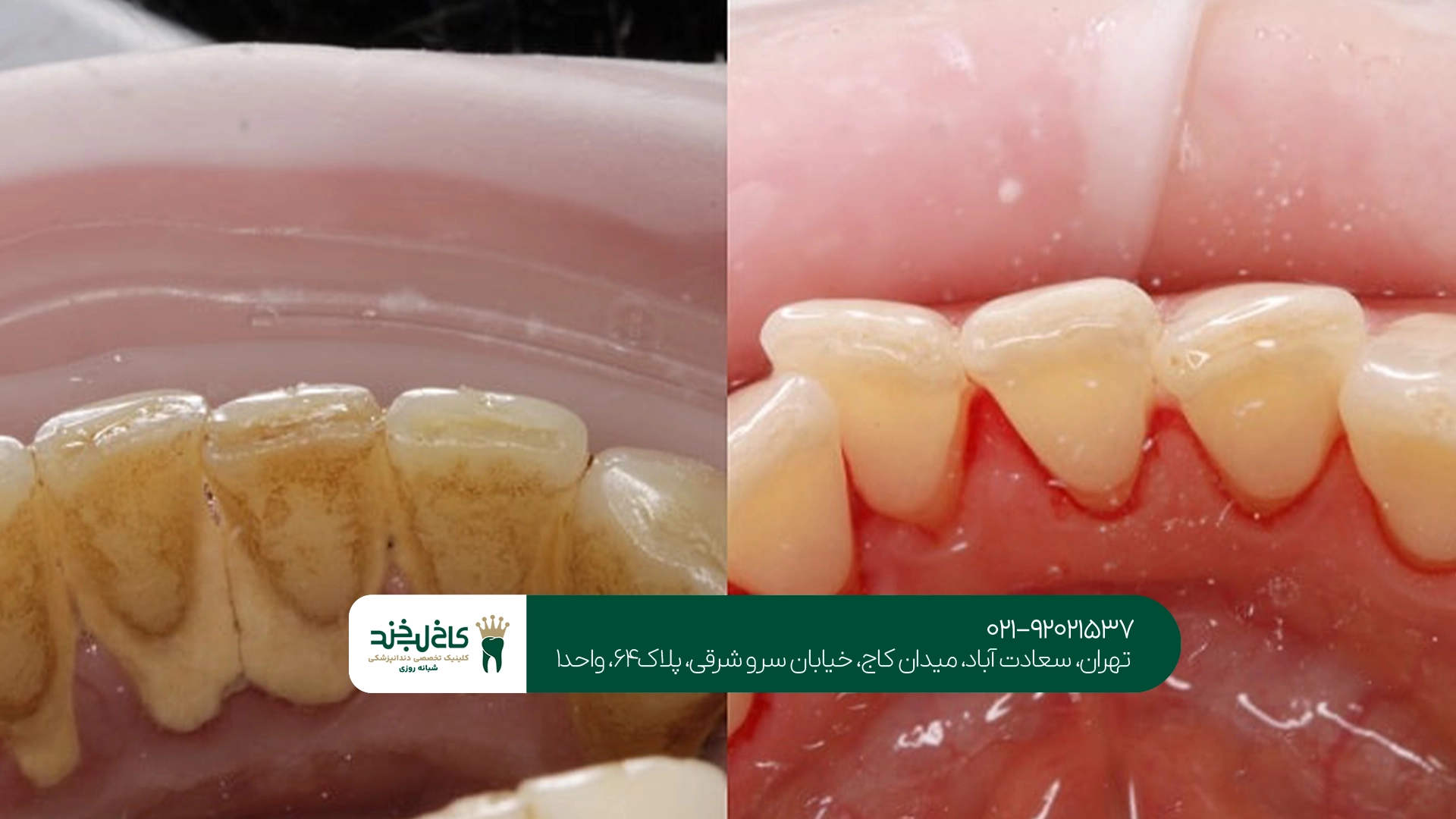 کلینیک سفید کردن دندان