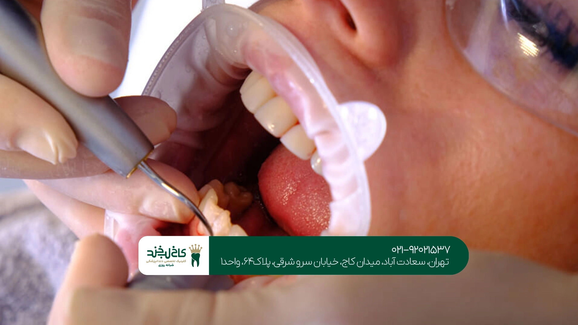 قیمت بلیچینگ دندان