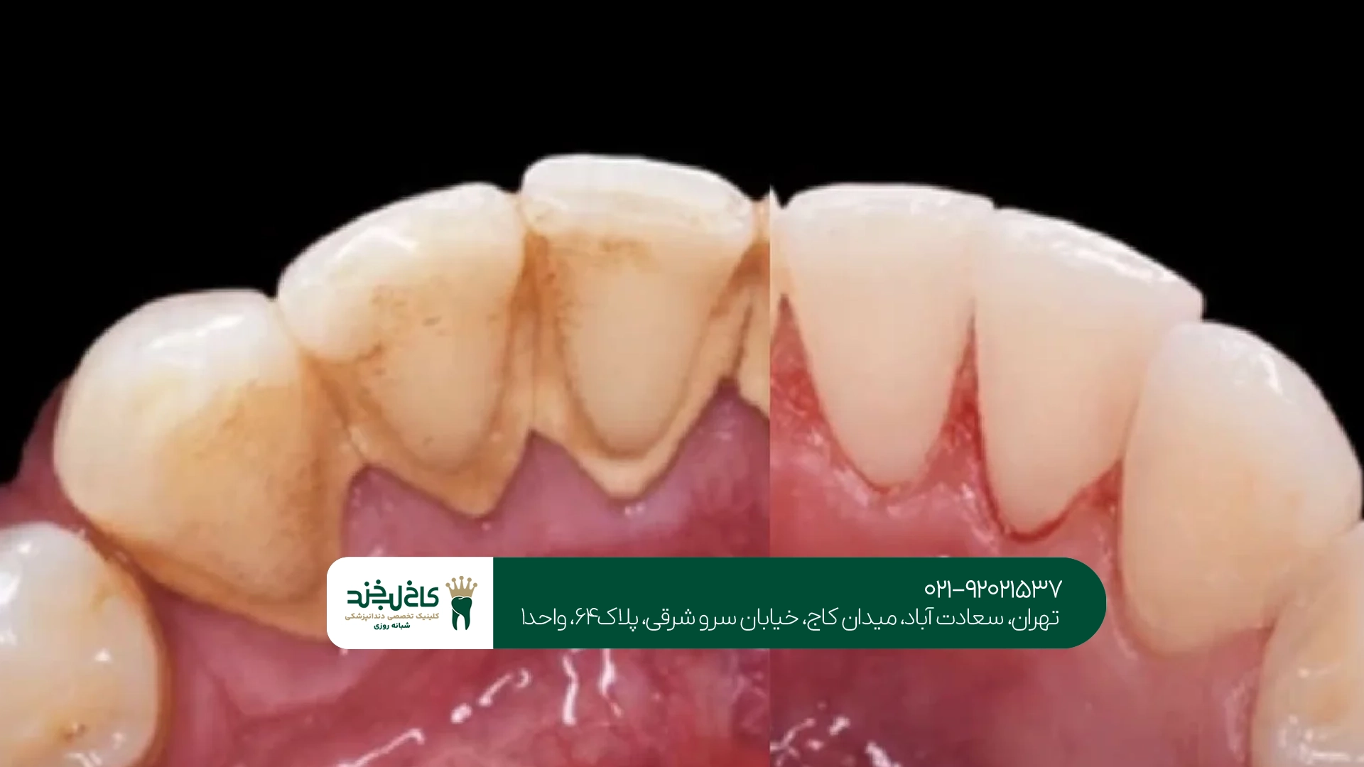 برای زردی دندان جرم گیری بهتر است یا بلیچینگ؟