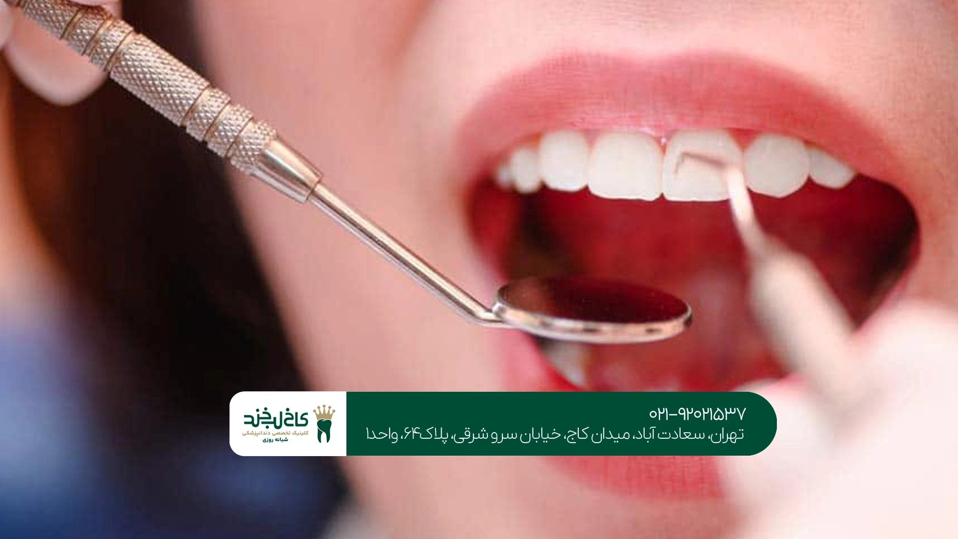 مراحل جرم گیری دندان