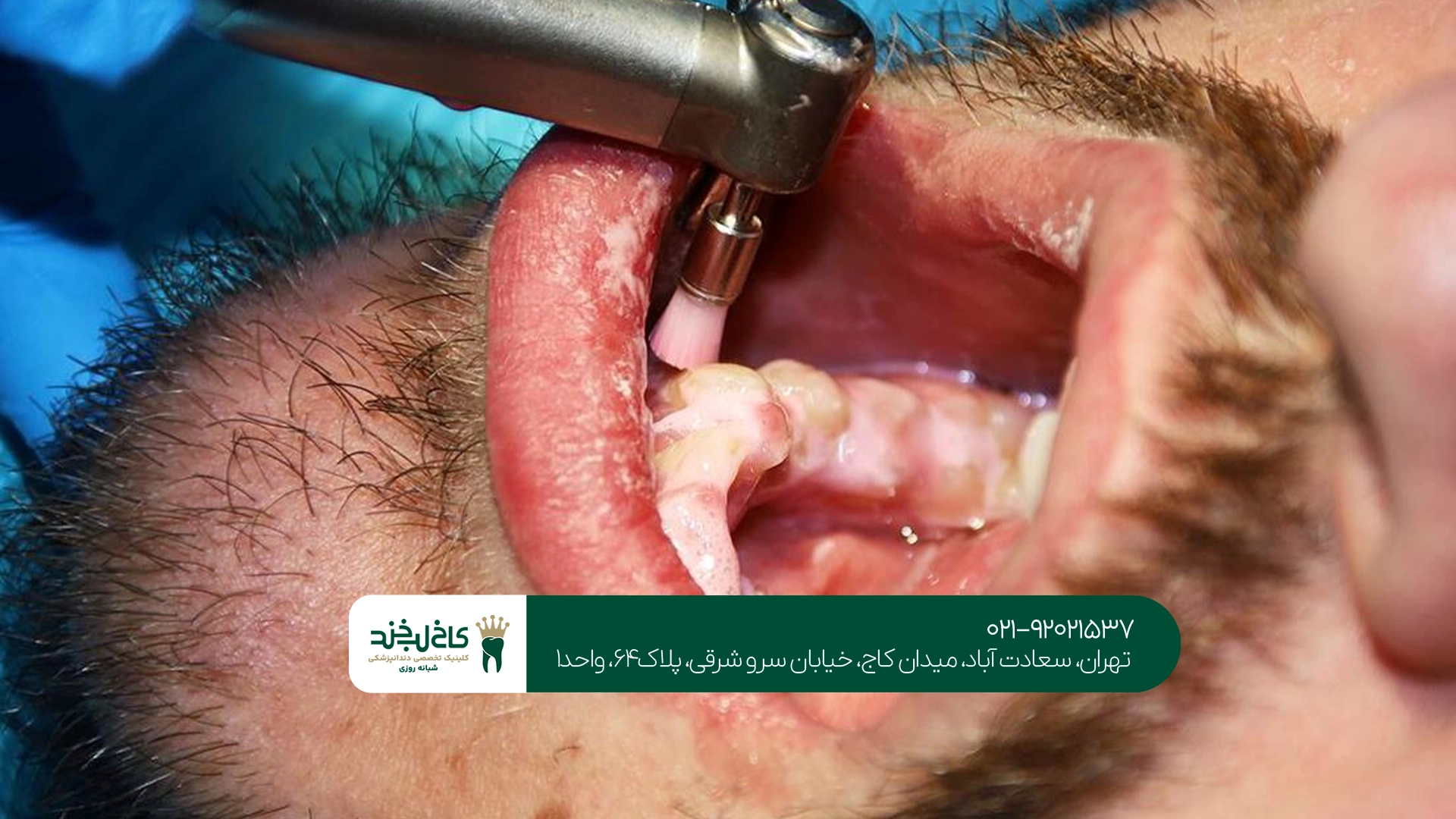 جرمگیری دندان چیست جرمگیری دندان چیست