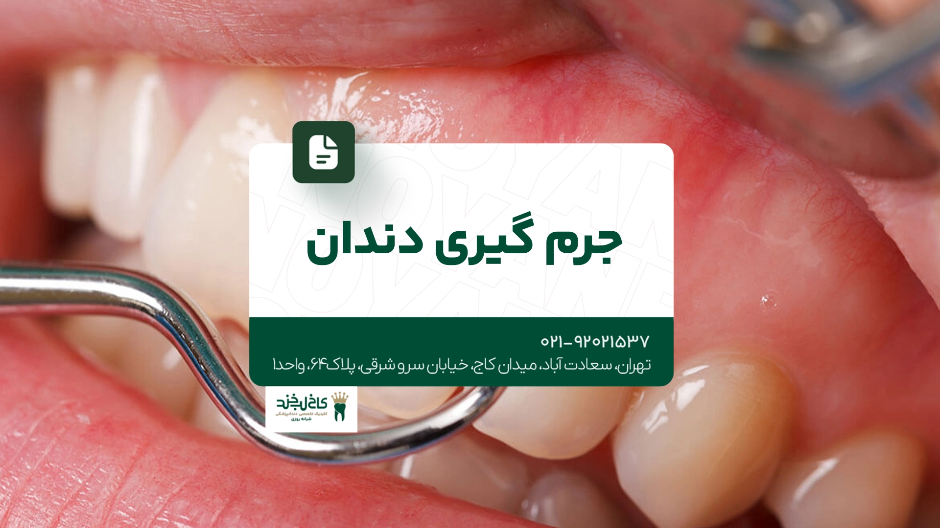 جرم گیری دندان